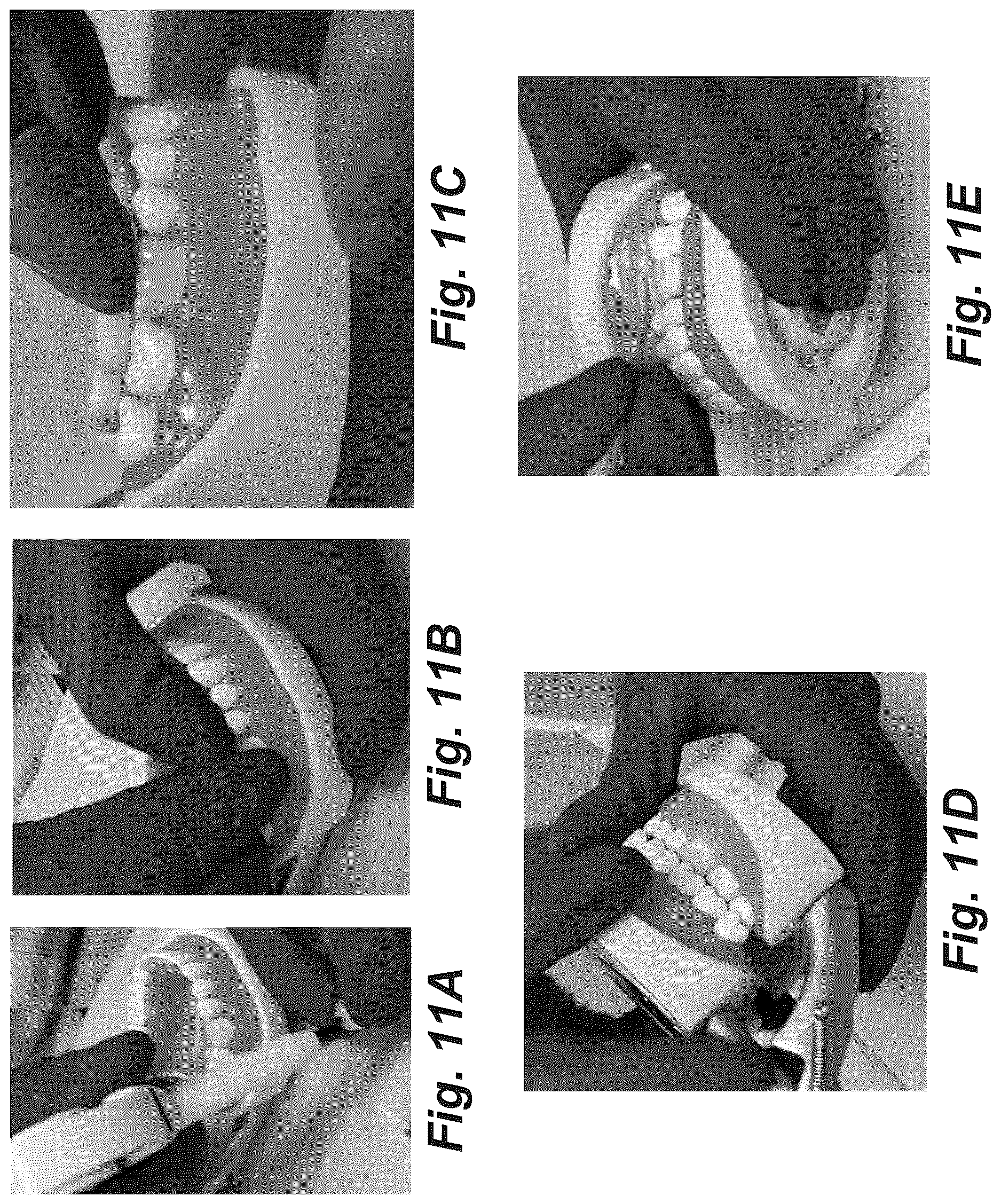 Patent US12616555 Figure 12 – Dental crown and method of use
