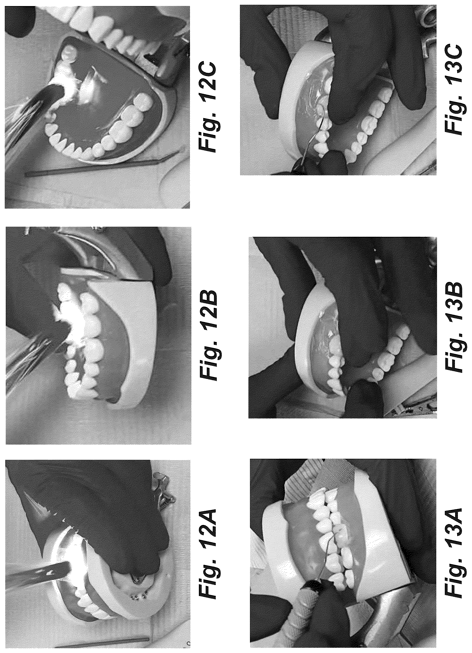 Patent US12616555 Figure 13 – Dental crown and method of use