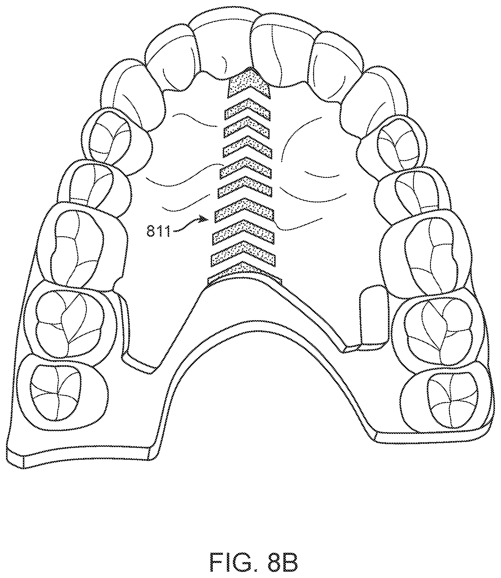 Patent US12616556 Figure 11 – Methods for direct fabrication of appliances for palate expansion
