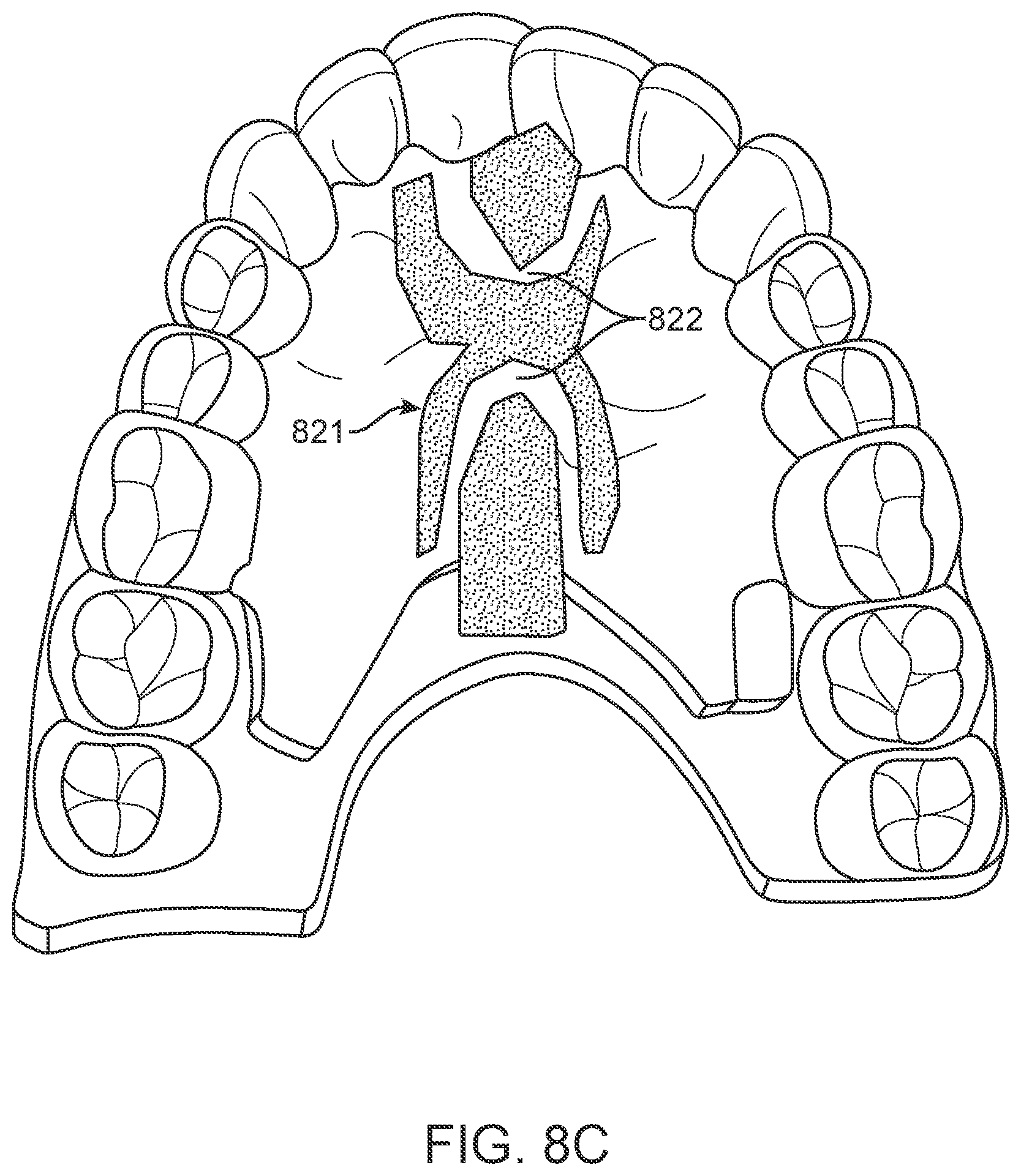 Patent US12616556 Figure 12 – Methods for direct fabrication of appliances for palate expansion