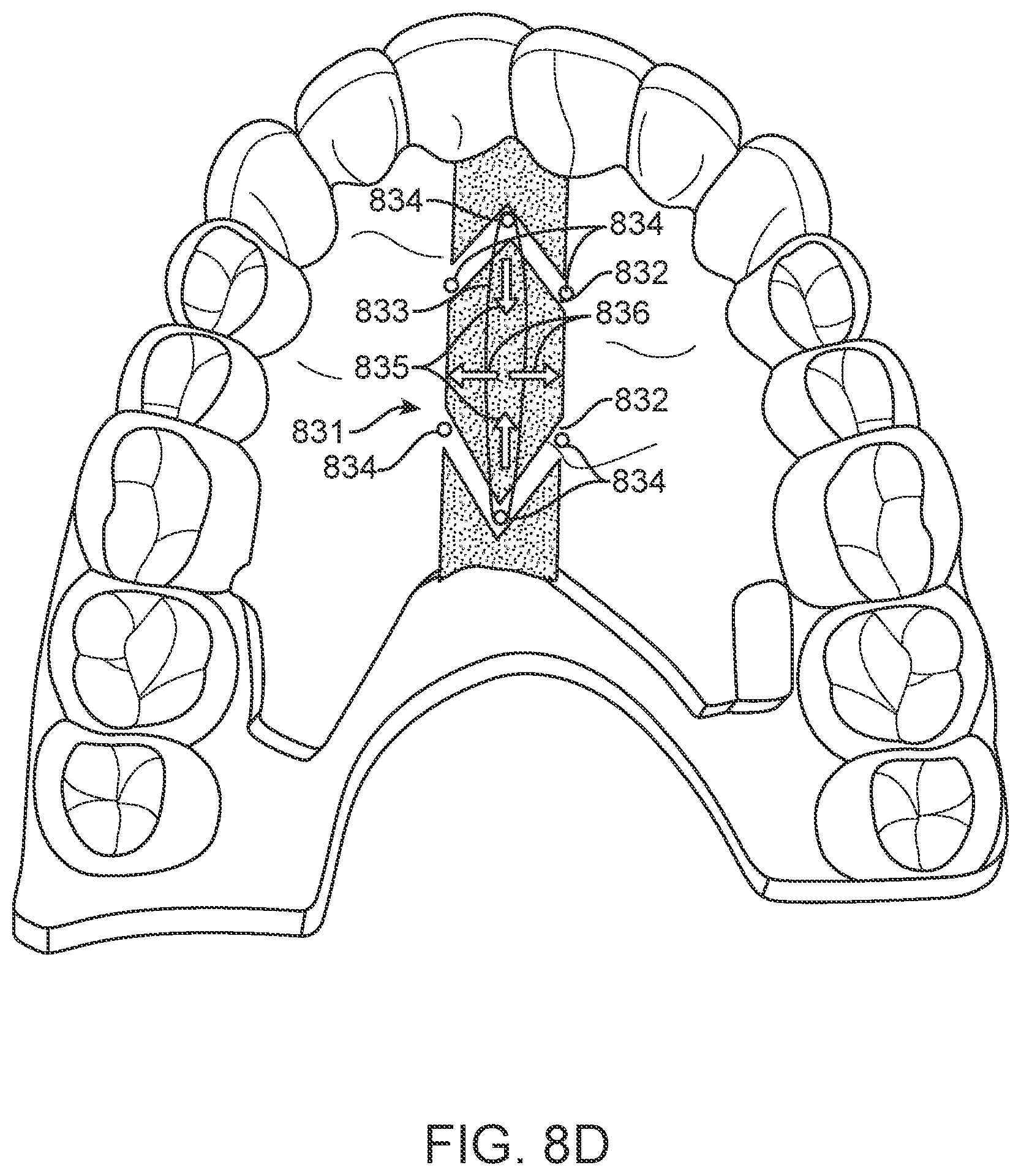 Patent US12616556 Figure 13 – Methods for direct fabrication of appliances for palate expansion