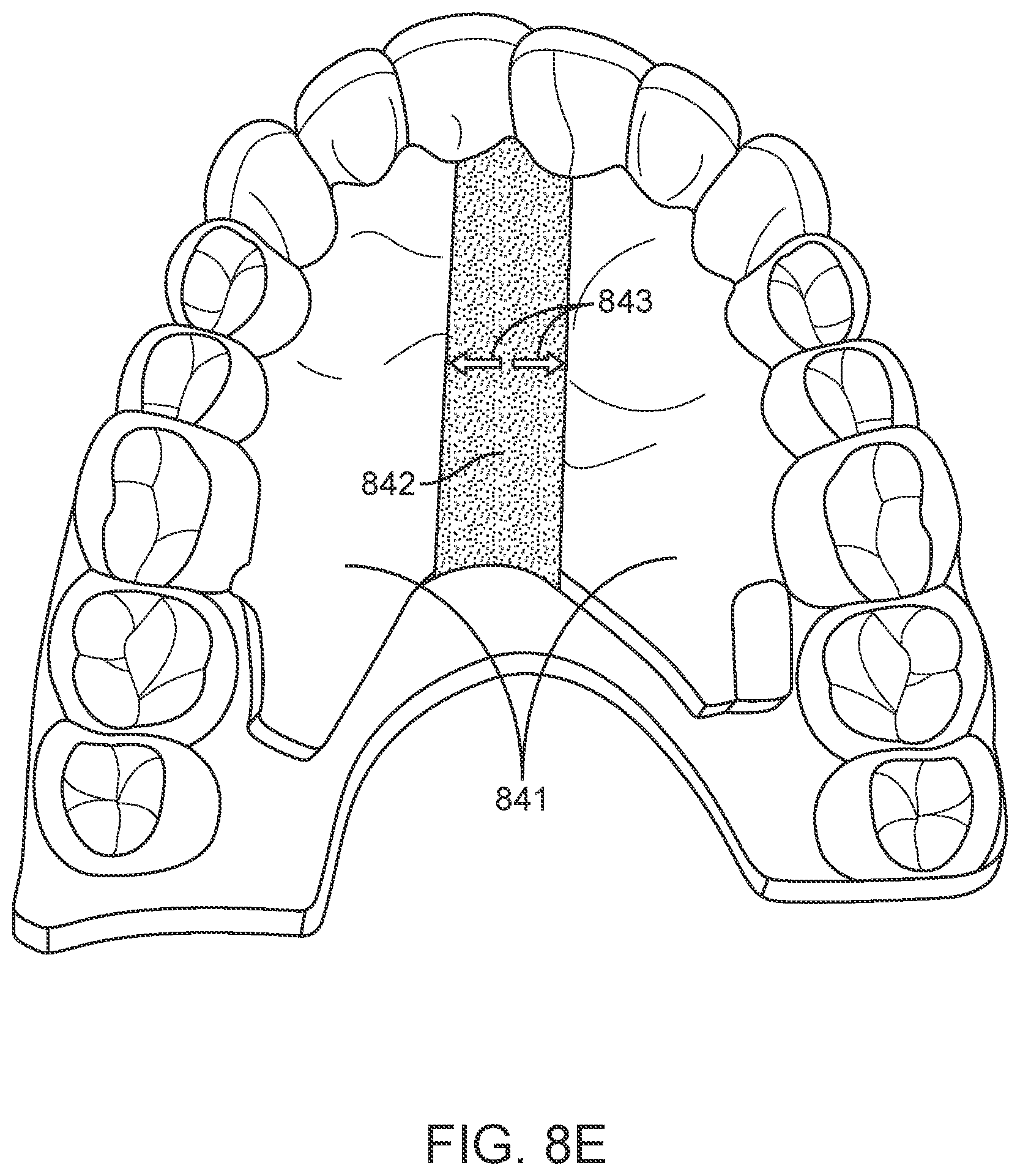 Patent US12616556 Figure 14 – Methods for direct fabrication of appliances for palate expansion