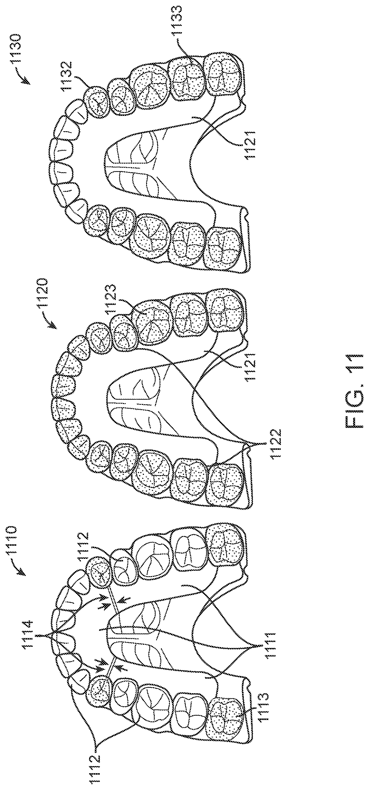Patent US12616556 Figure 20 – Methods for direct fabrication of appliances for palate expansion