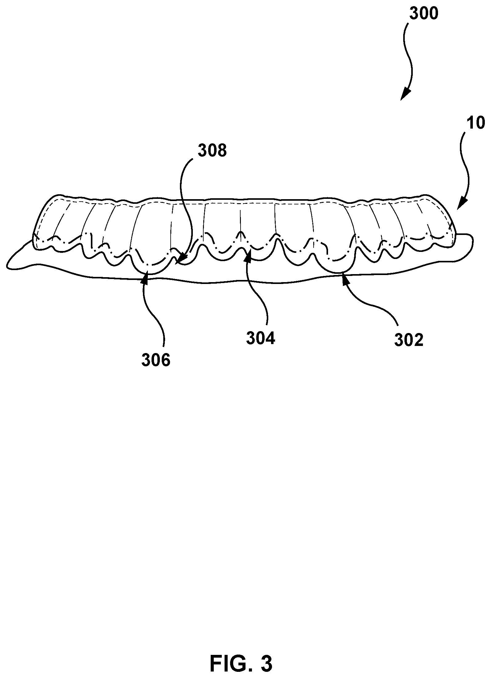 Patent US12616557 Figure 3 – Systems and methods for determining an edge of orthodontic appliances