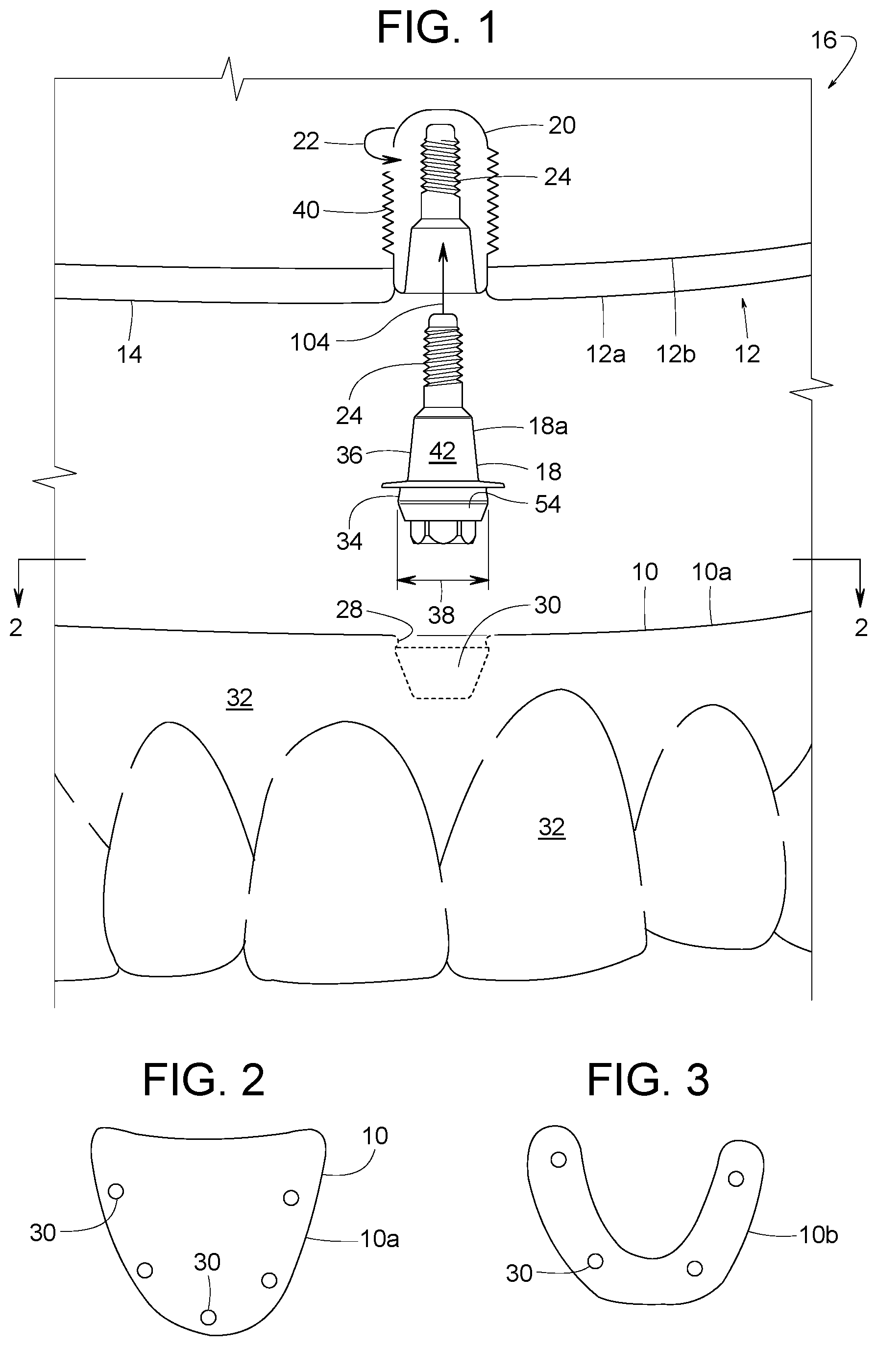Patent US12616558 Figure 1 – Direct-snap dental abutment systems