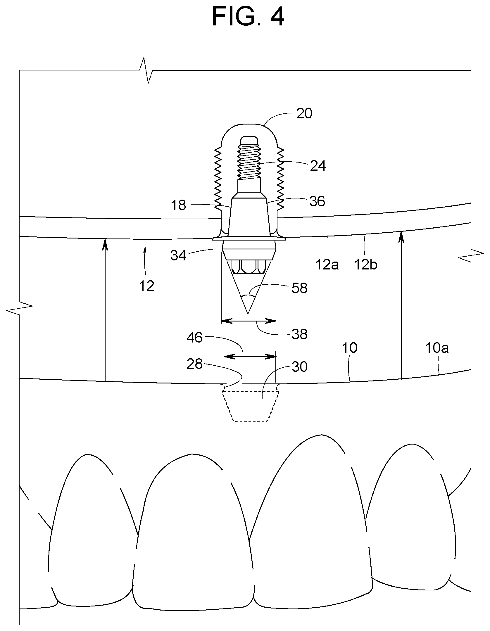 Patent US12616558 Figure 2 – Direct-snap dental abutment systems