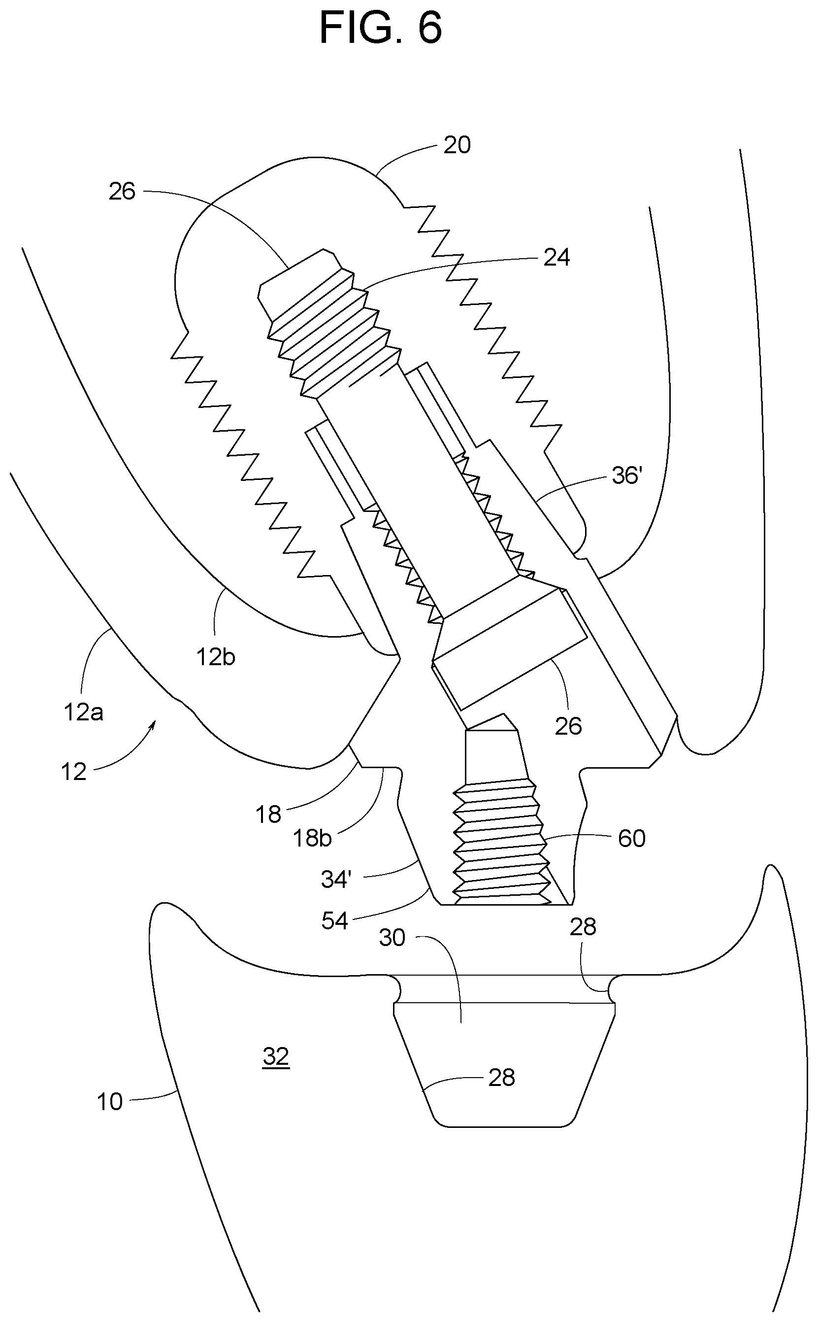 Patent US12616558 Figure 4 – Direct-snap dental abutment systems