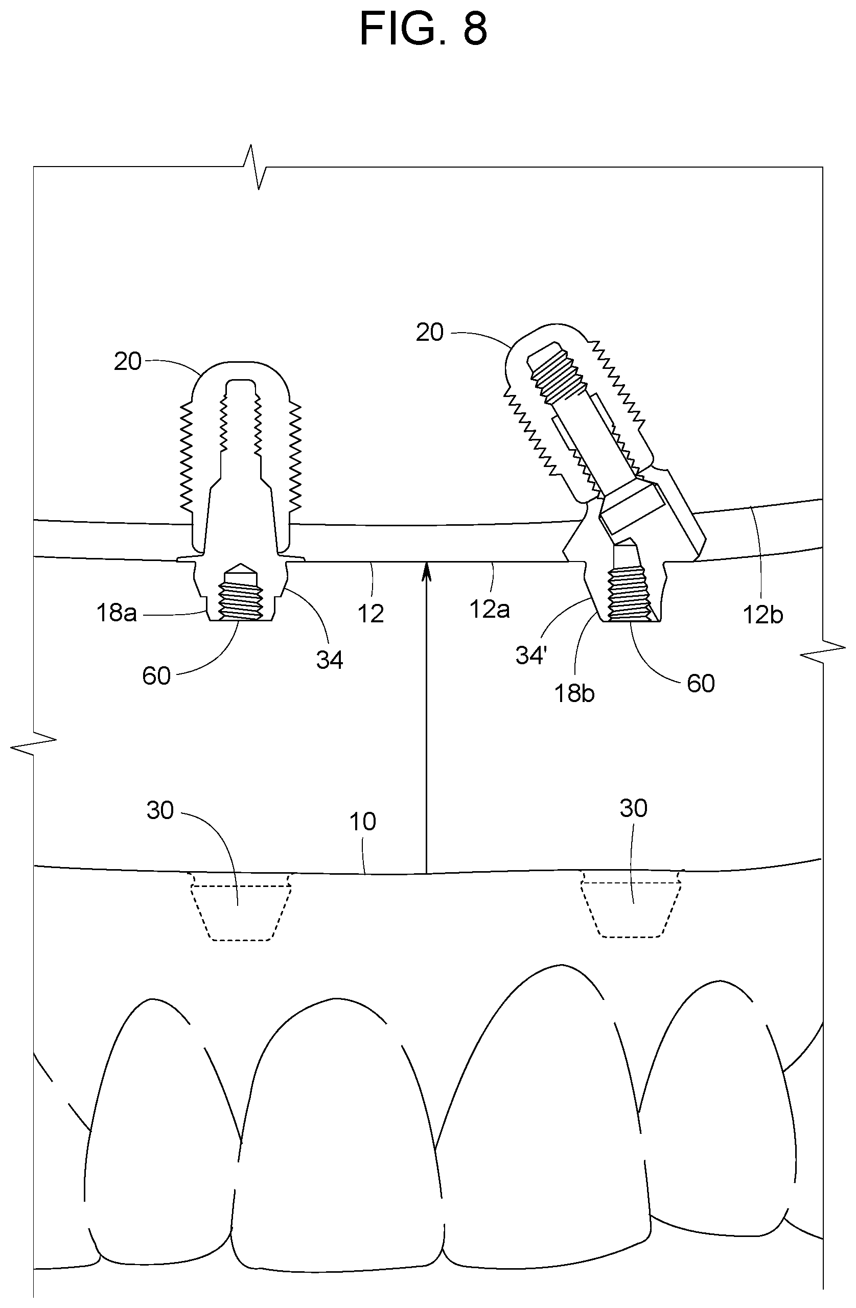 Patent US12616558 Figure 6 – Direct-snap dental abutment systems