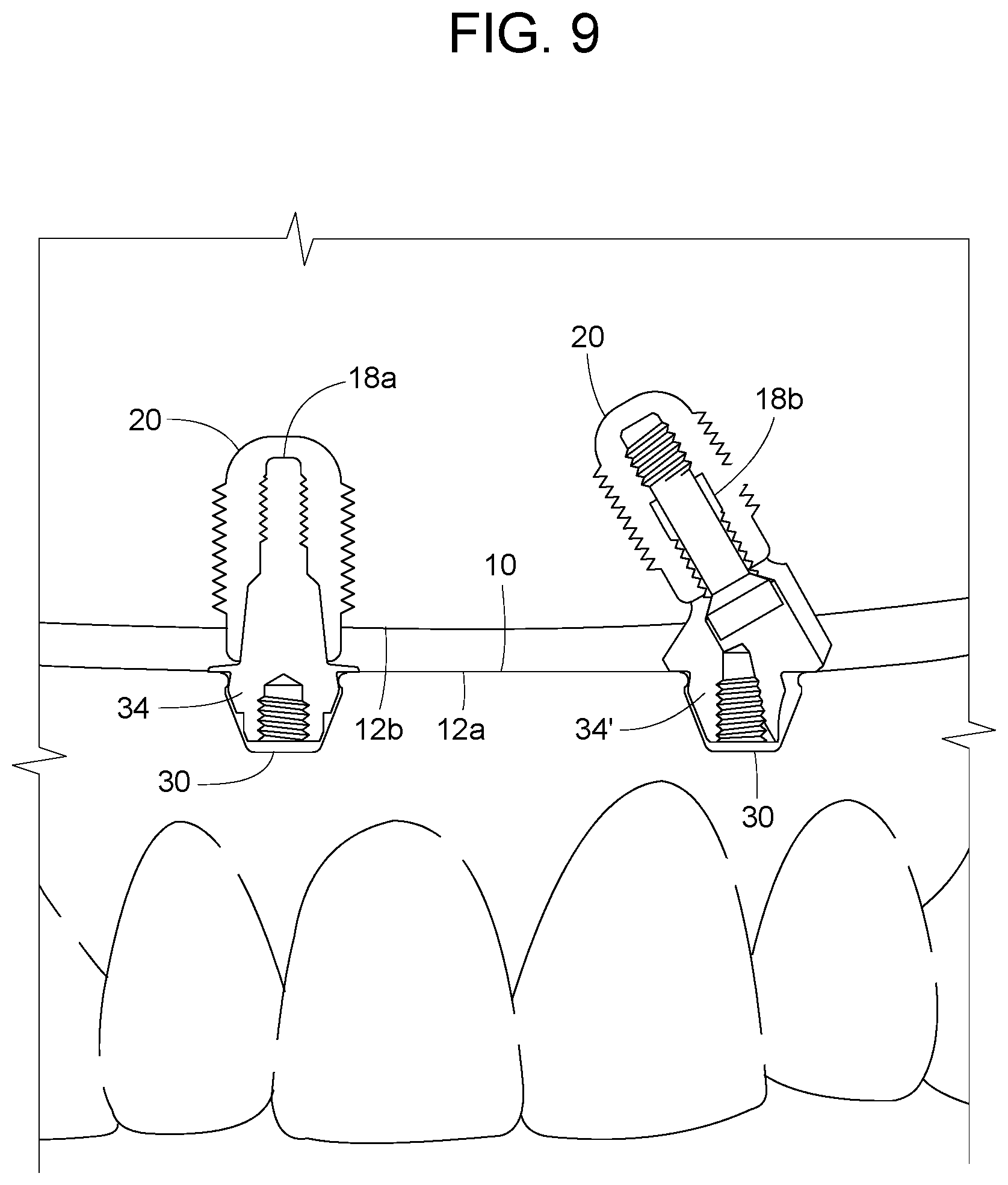 Patent US12616558 Figure 7 – Direct-snap dental abutment systems