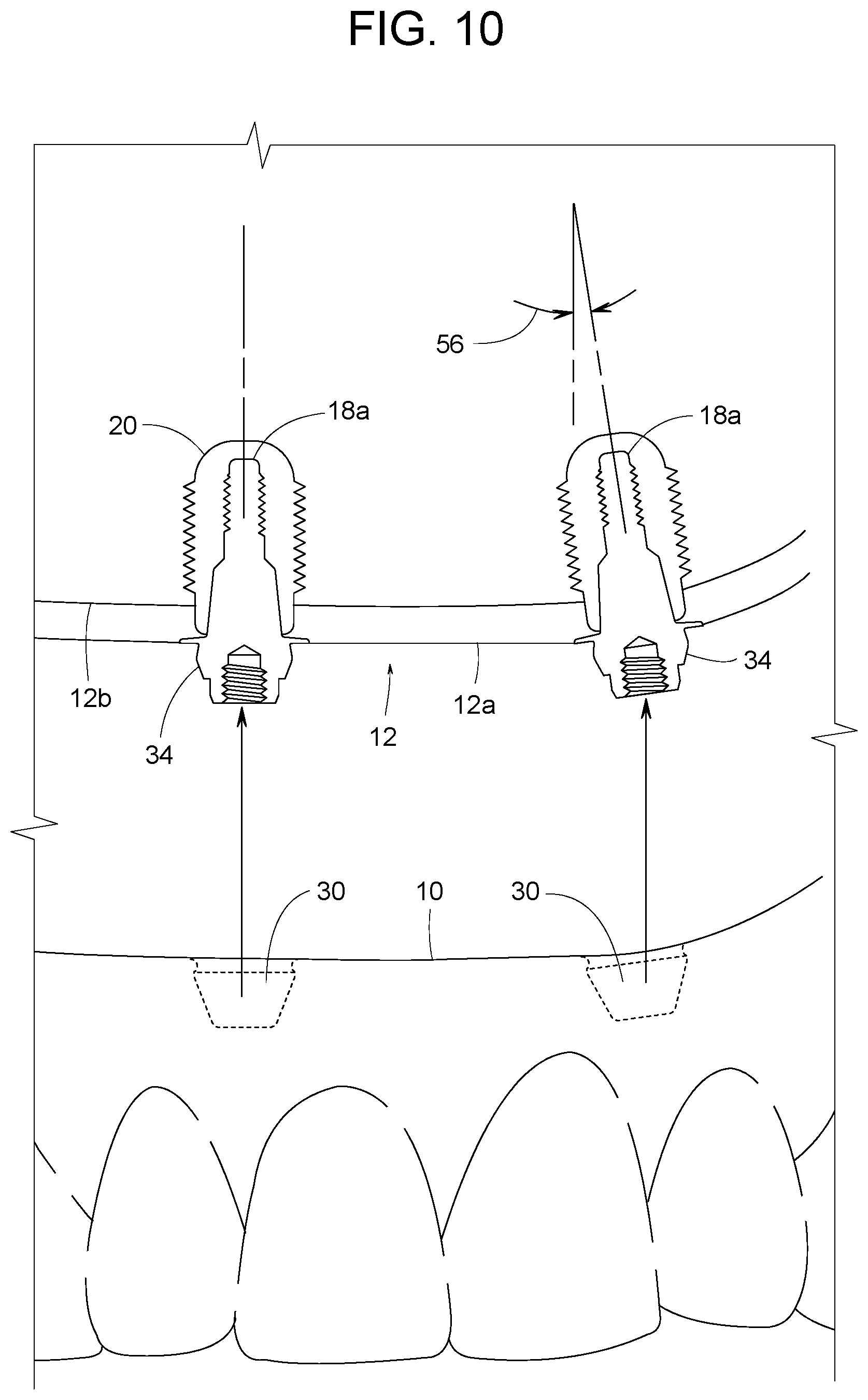 Patent US12616558 Figure 8 – Direct-snap dental abutment systems