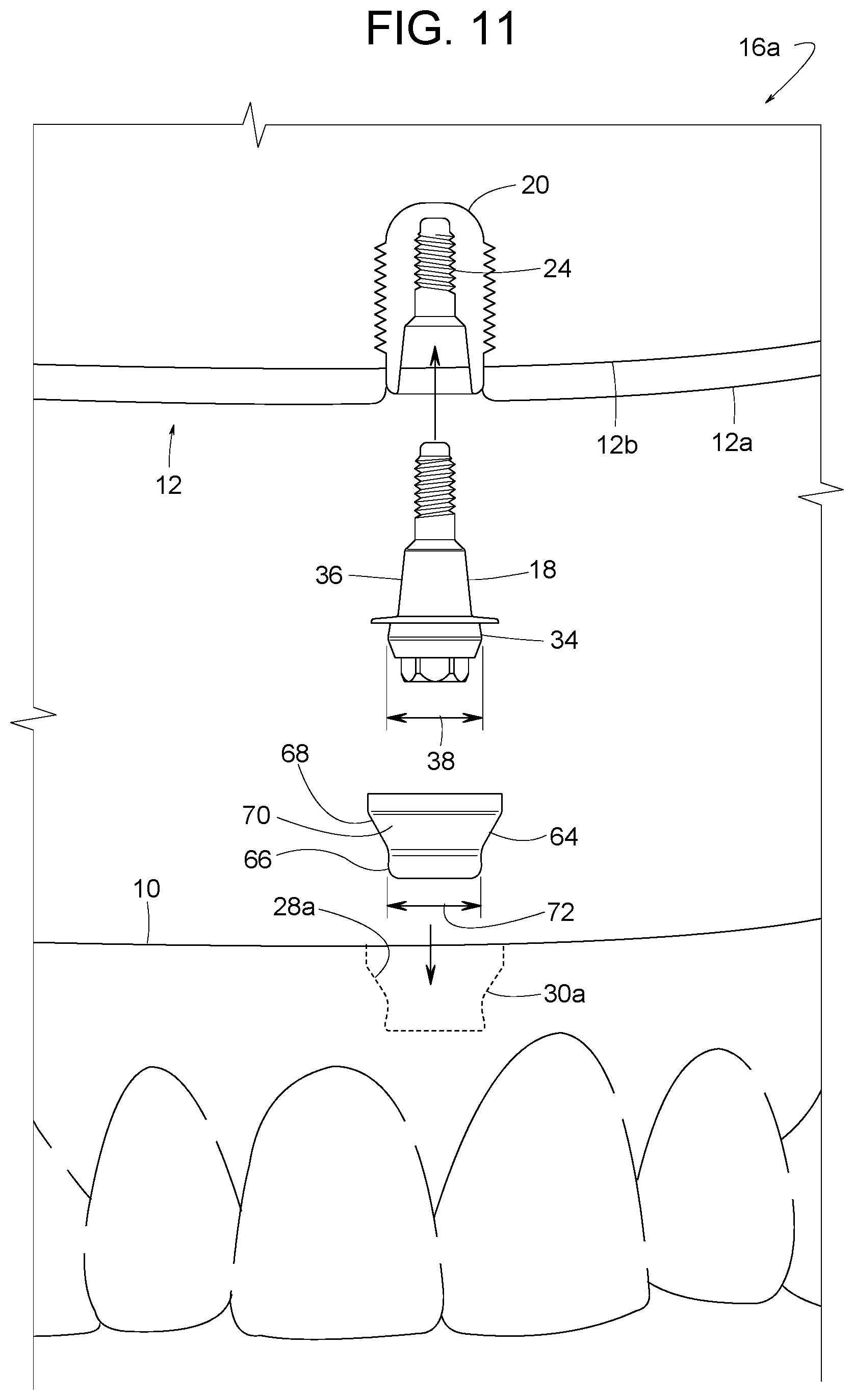 Patent US12616558 Figure 9 – Direct-snap dental abutment systems