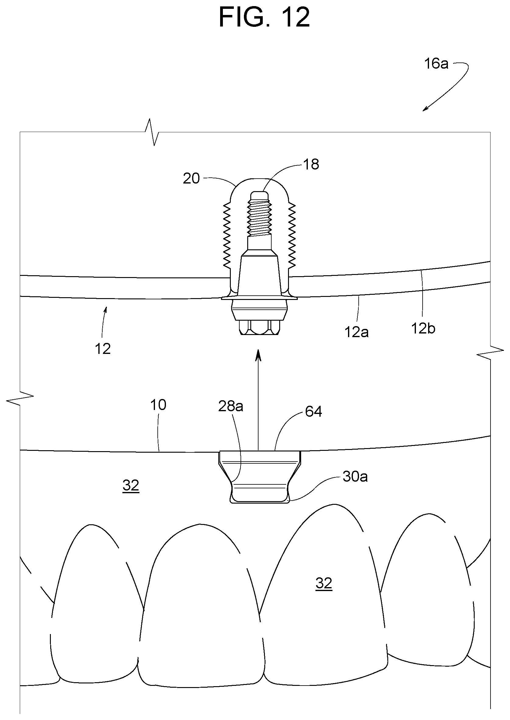 Patent US12616558 Figure 10 – Direct-snap dental abutment systems
