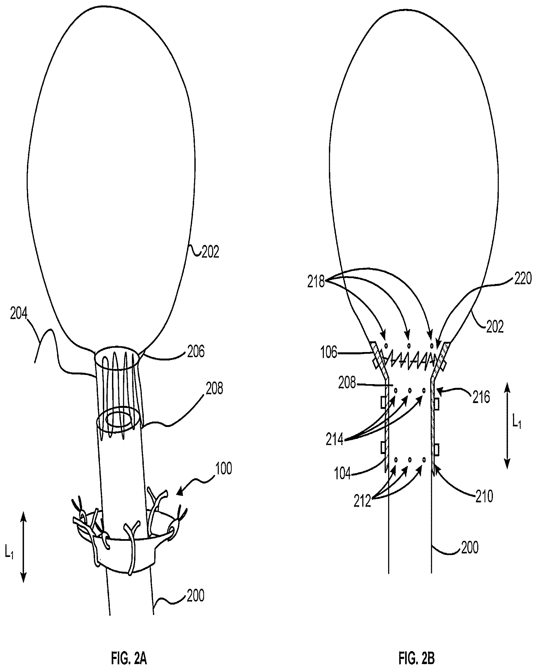 Patent US12616563 Figure 2 – Device for mitigating urinary incontinence post prostatectomy