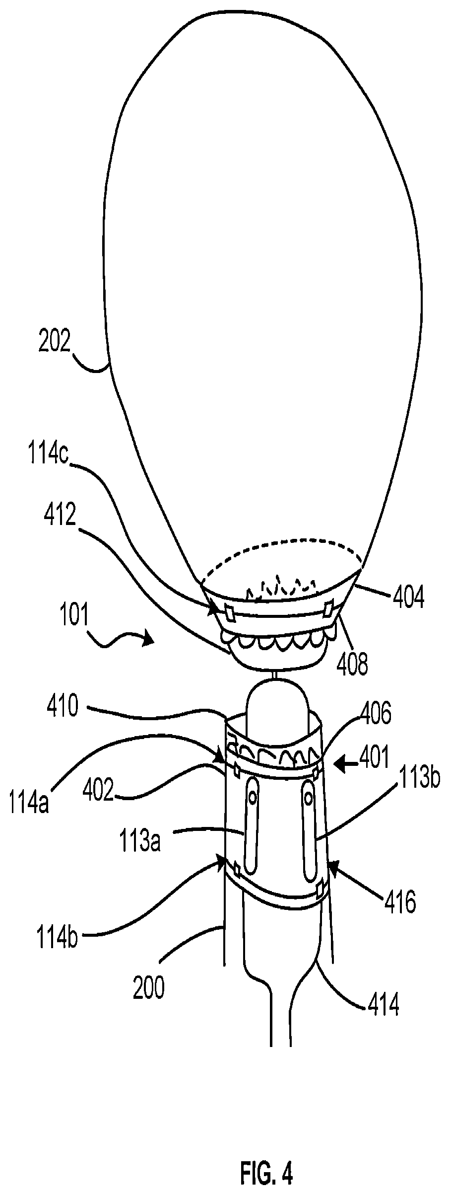 Patent US12616563 Figure 4 – Device for mitigating urinary incontinence post prostatectomy