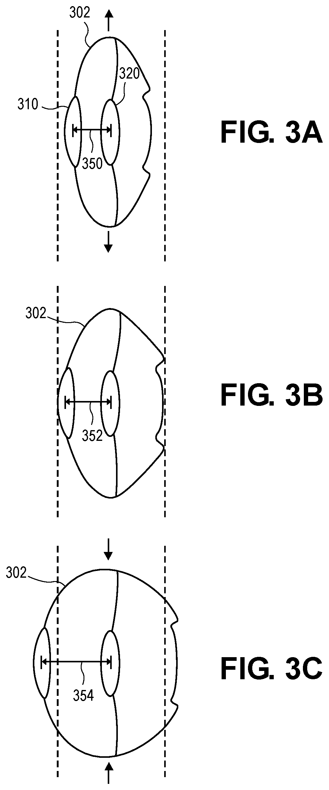 Patent US12616567 Figure 3 – Liquid accommodating intraocular lens with suspended central lens