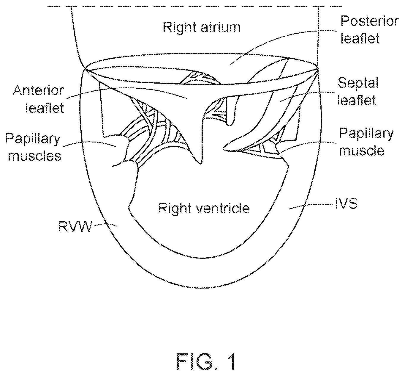 Patent US12616568 Figure 1 – Two stage tricuspid valve implant