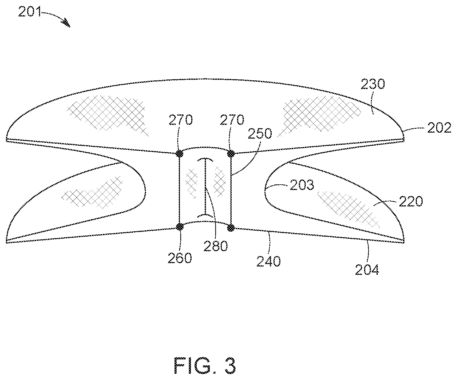 Patent US12616568 Figure 3 – Two stage tricuspid valve implant