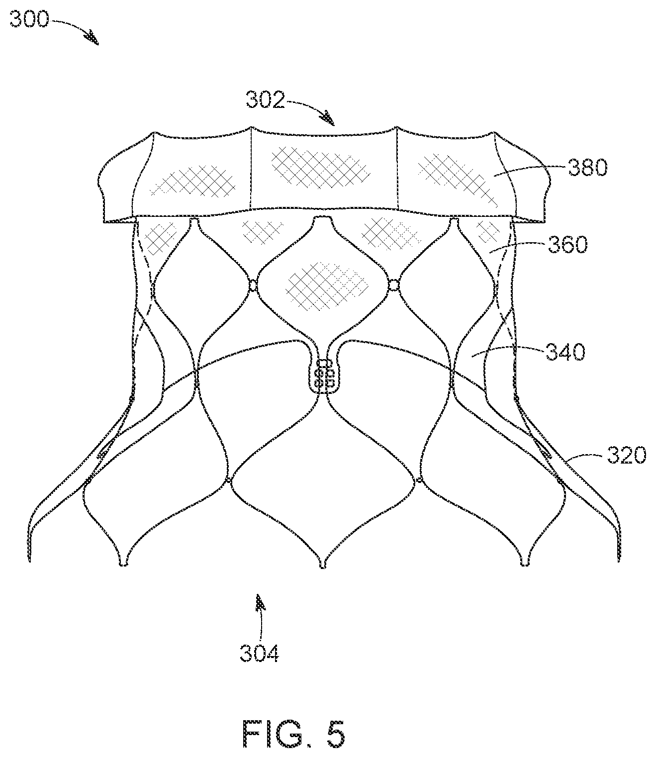 Patent US12616568 Figure 5 – Two stage tricuspid valve implant