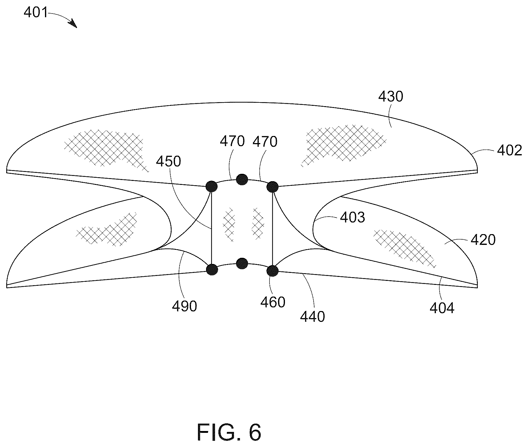 Patent US12616568 Figure 6 – Two stage tricuspid valve implant