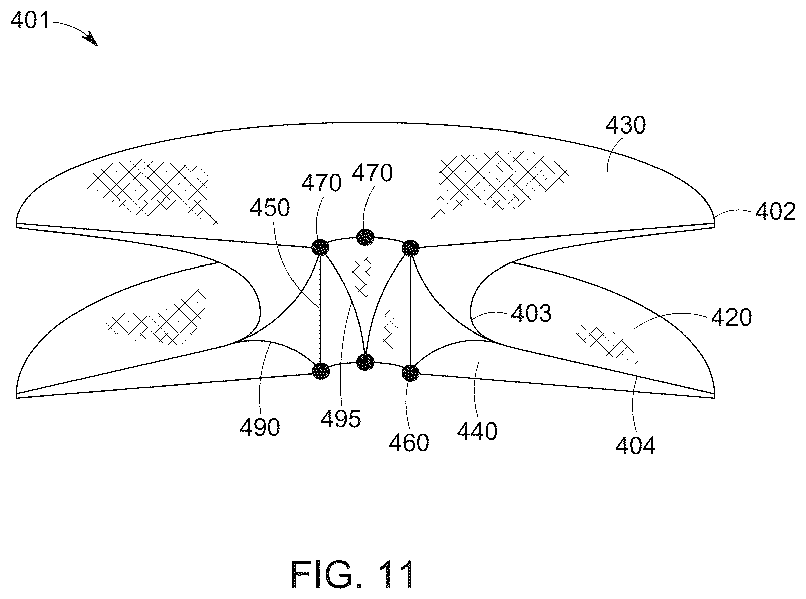 Patent US12616568 Figure 16 – Two stage tricuspid valve implant