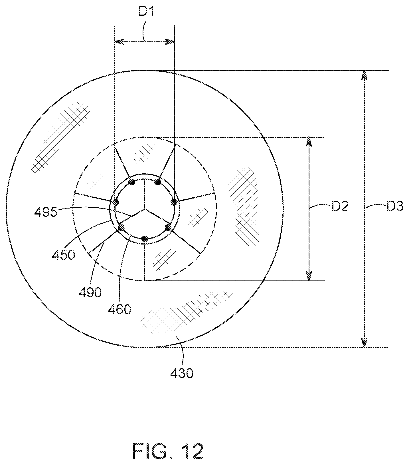 Patent US12616568 Figure 17 – Two stage tricuspid valve implant