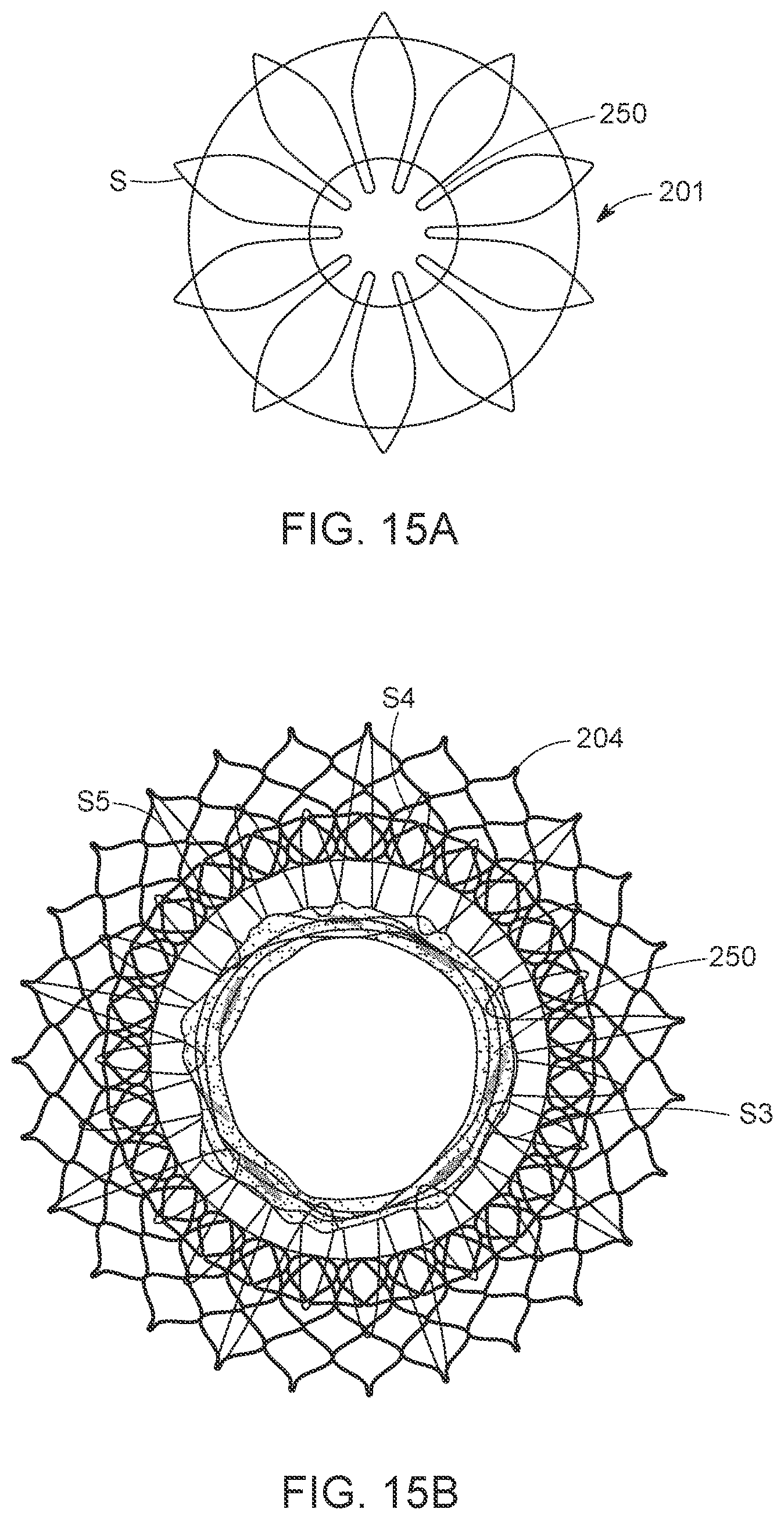 Patent US12616568 Figure 20 – Two stage tricuspid valve implant
