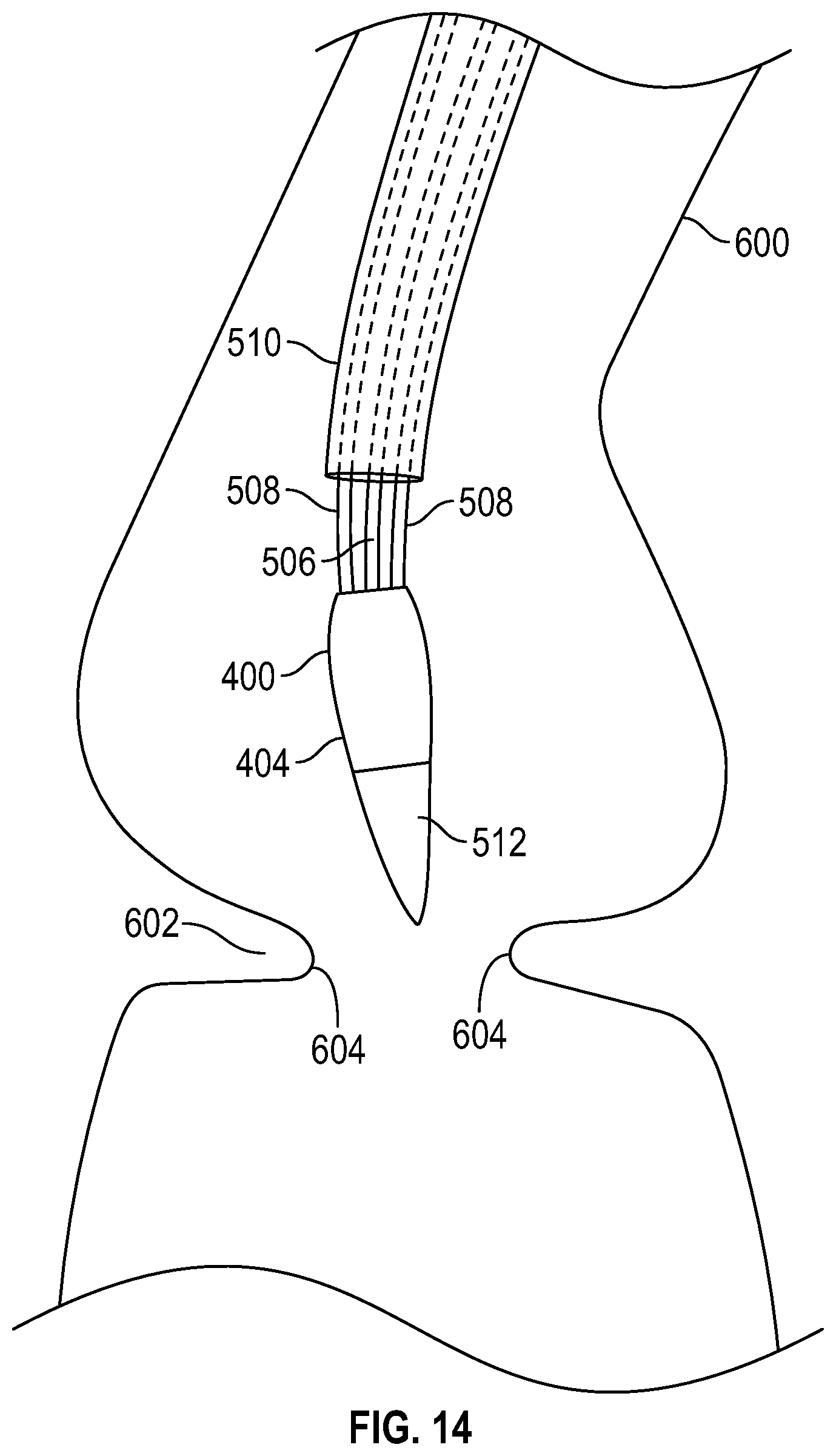 Patent US12616569 Figure 11 – Prosthetic heart valve having non-cylindrical frame