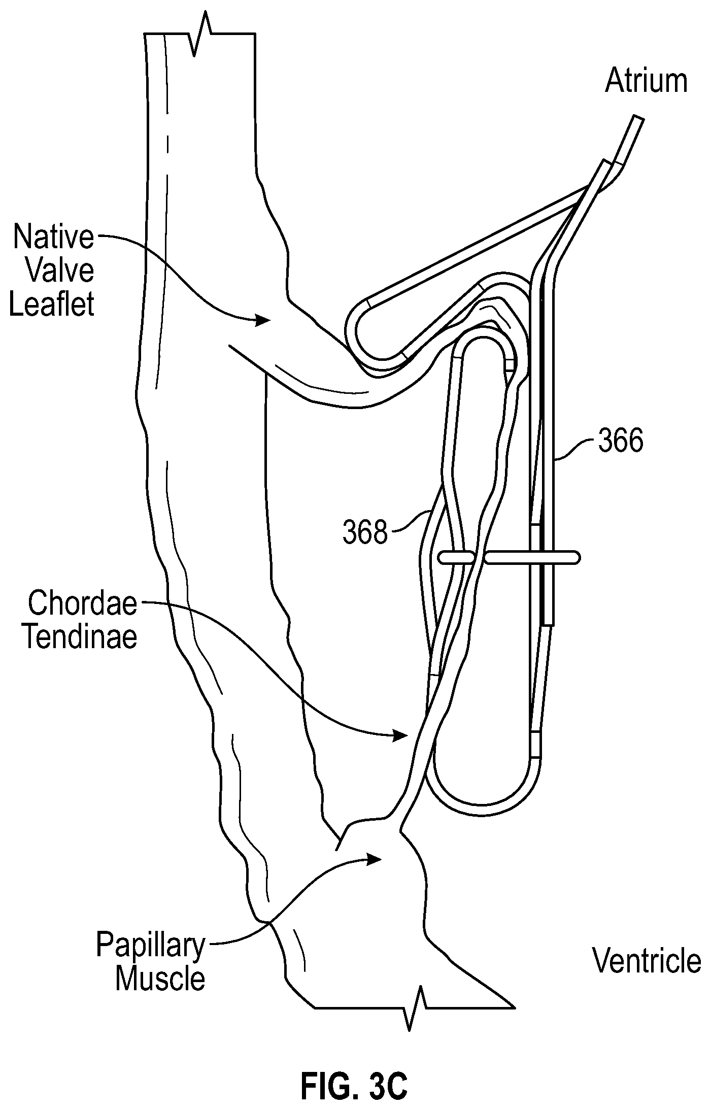 Patent US12616570 Figure 11 – Three-dimensional thin-film leaflet valve device