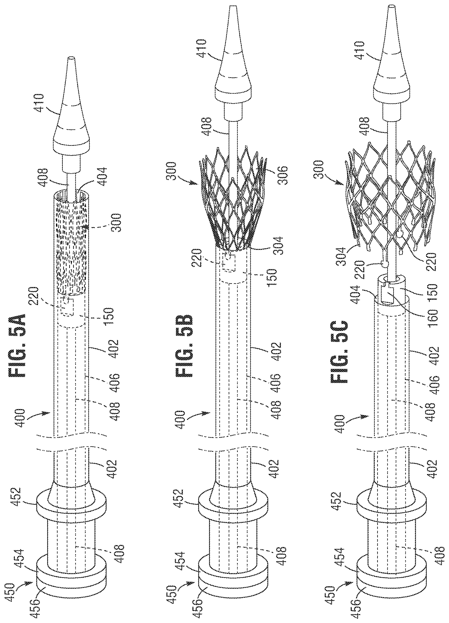 Patent US12616571 Figure 4 – Implantable frame and frame retaining mechanism