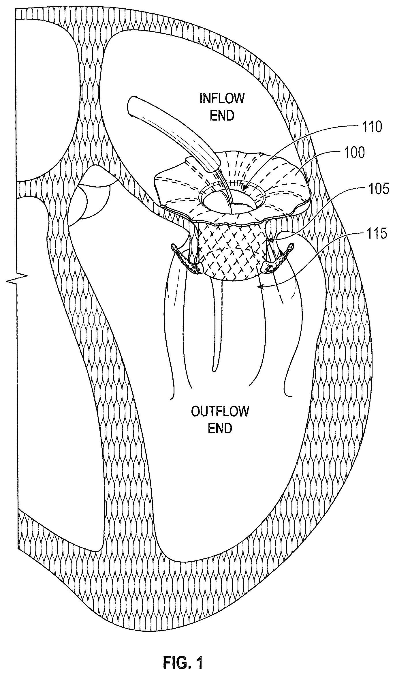 Patent US12616572 Figure 1 – Devices, systems, and methods for a valve replacement