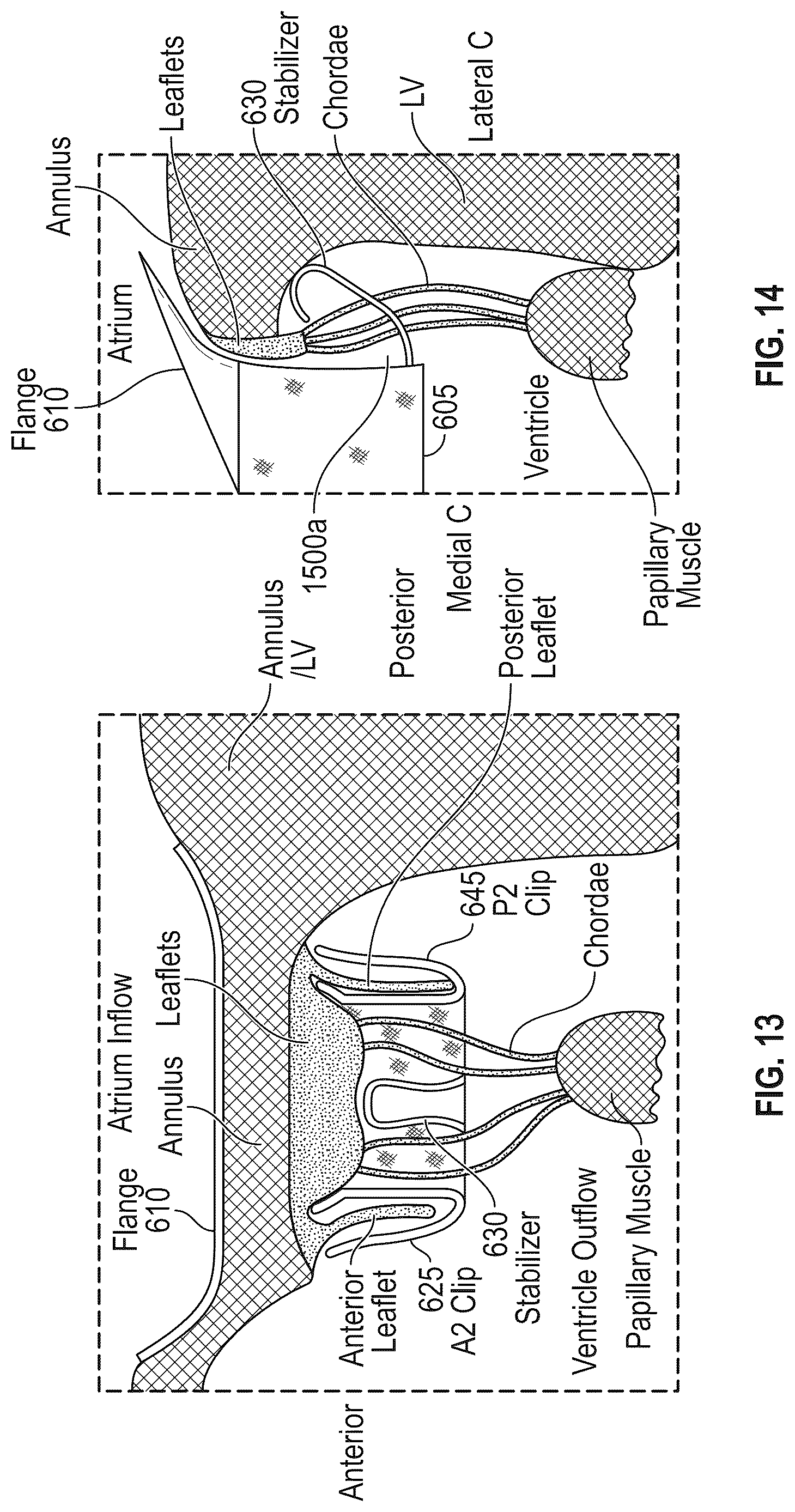 Patent US12616572 Figure 10 – Devices, systems, and methods for a valve replacement