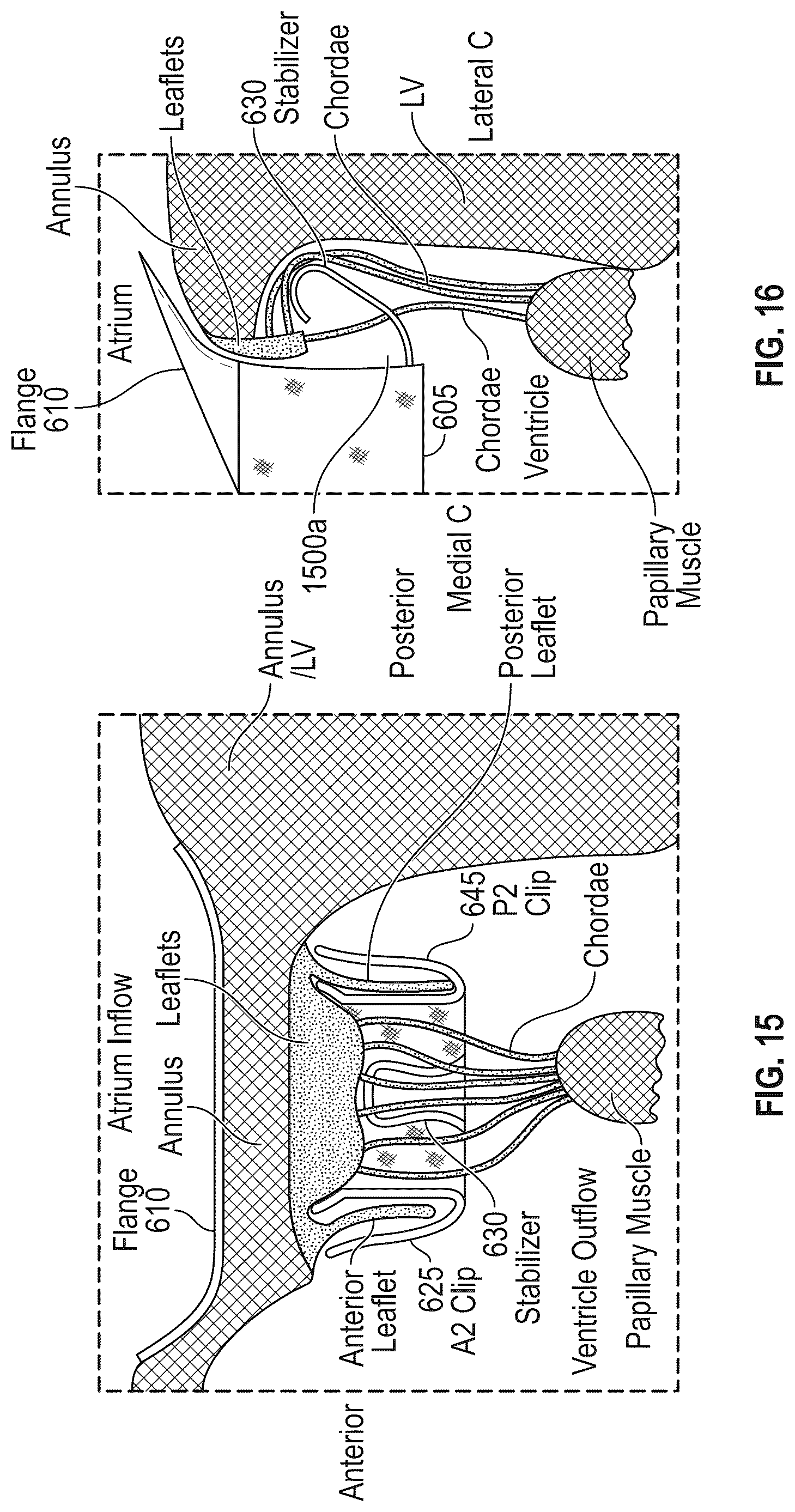 Patent US12616572 Figure 11 – Devices, systems, and methods for a valve replacement