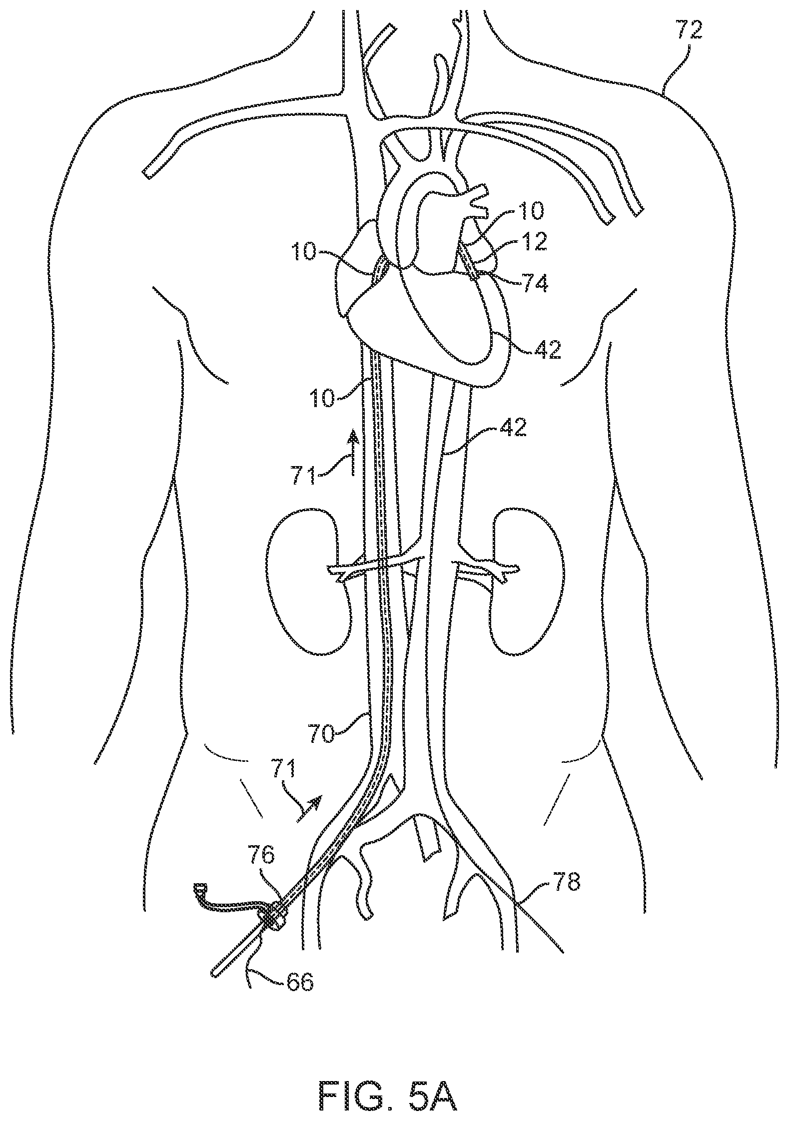 Patent US12616573 Figure 5 – Prosthetic valve delivery system and method