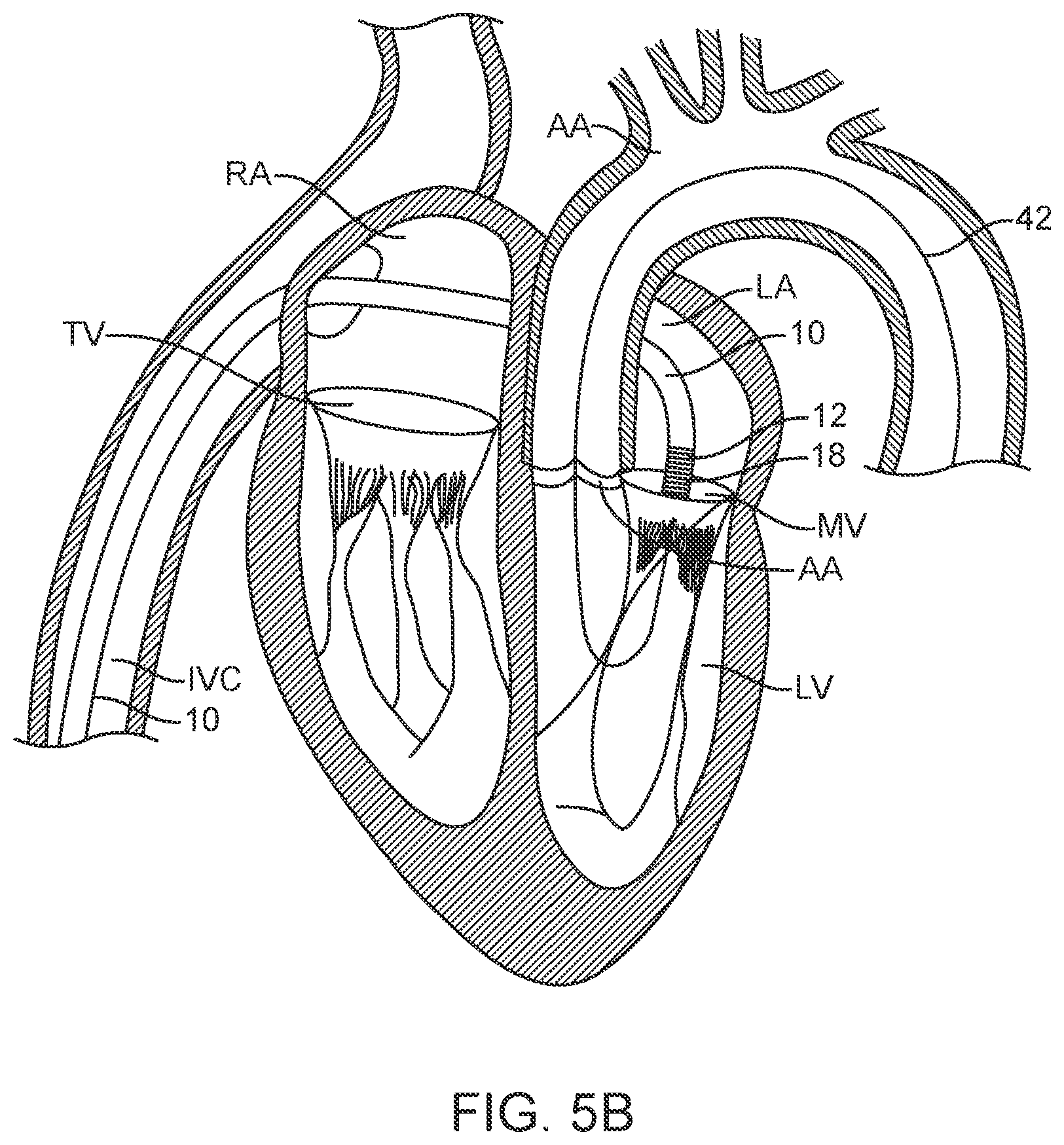 Patent US12616573 Figure 6 – Prosthetic valve delivery system and method