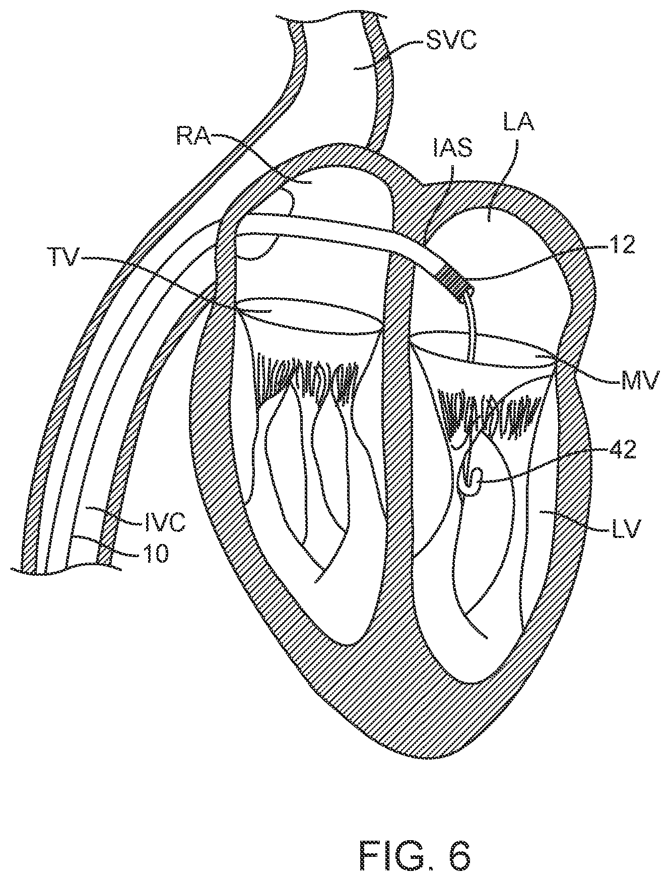 Patent US12616573 Figure 7 – Prosthetic valve delivery system and method