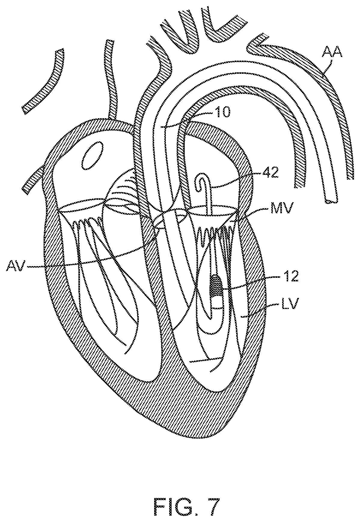 Patent US12616573 Figure 8 – Prosthetic valve delivery system and method