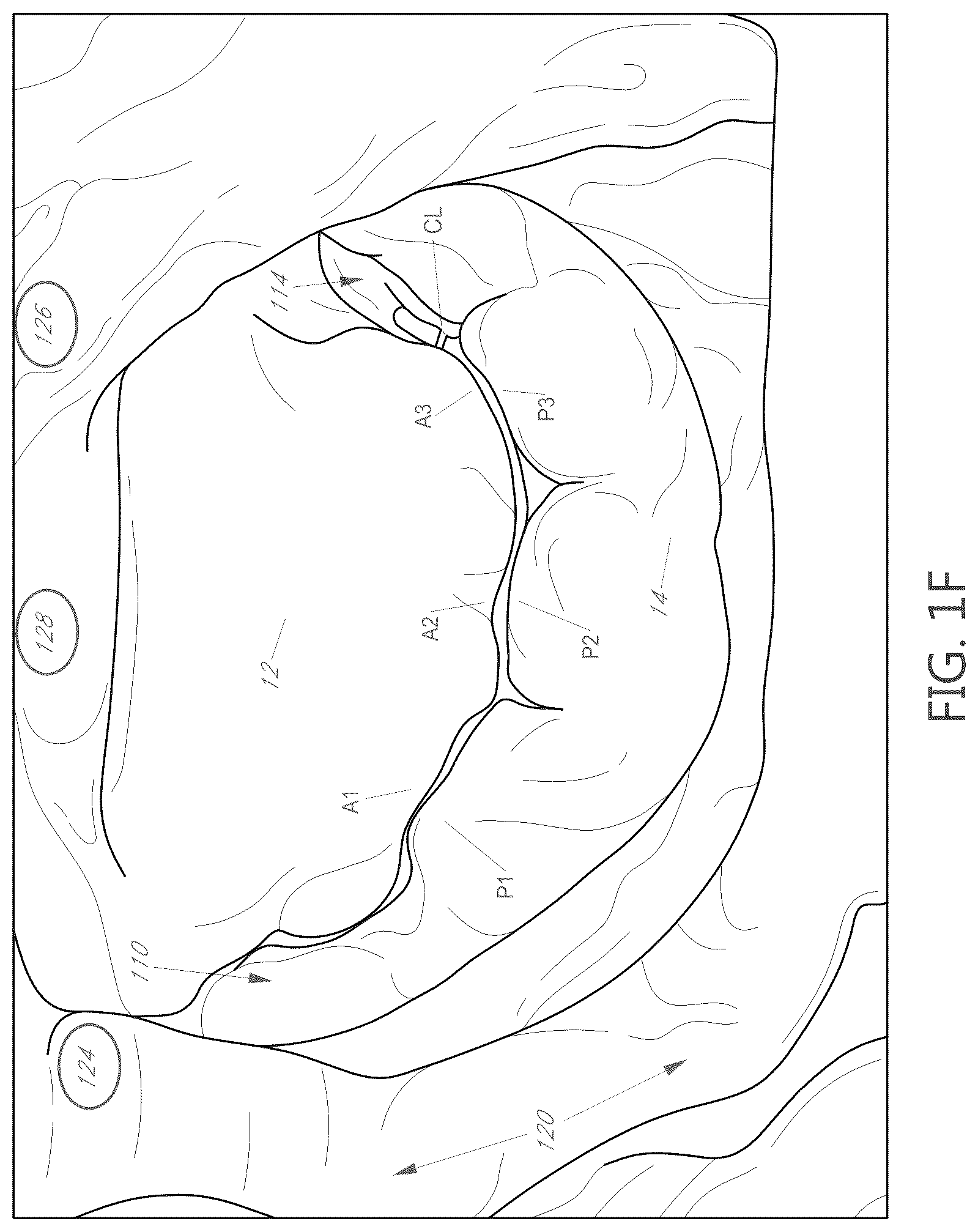 Patent US12616574 Figure 4 – Device, system, and method for transcatheter treatment of valvular regurgitation