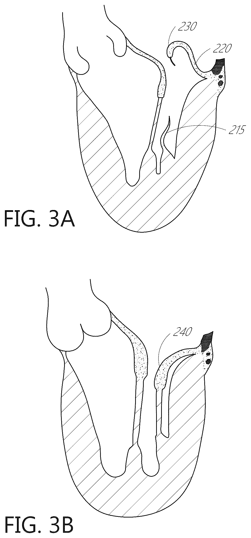 Patent US12616574 Figure 6 – Device, system, and method for transcatheter treatment of valvular regurgitation