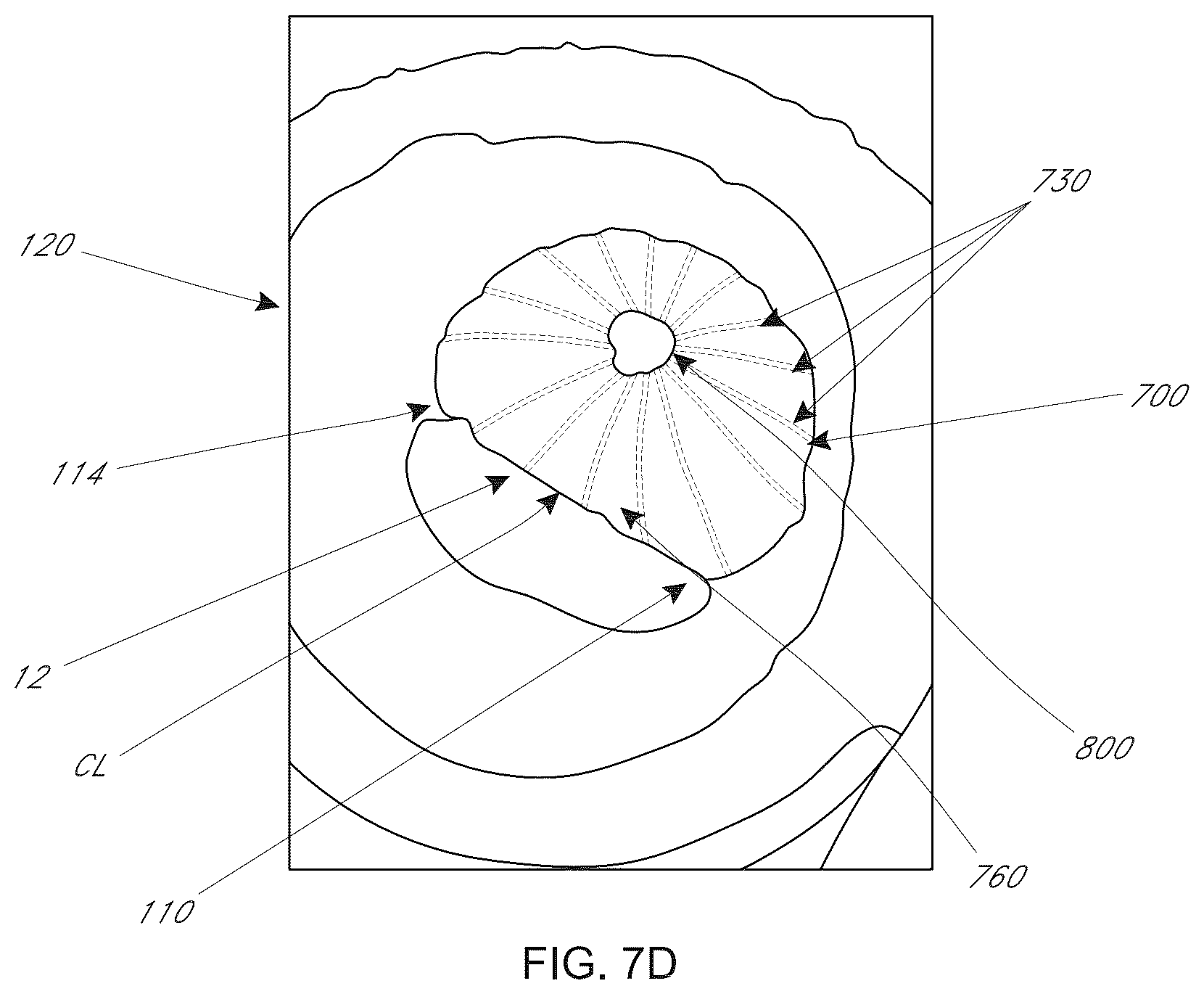 Patent US12616574 Figure 18 – Device, system, and method for transcatheter treatment of valvular regurgitation