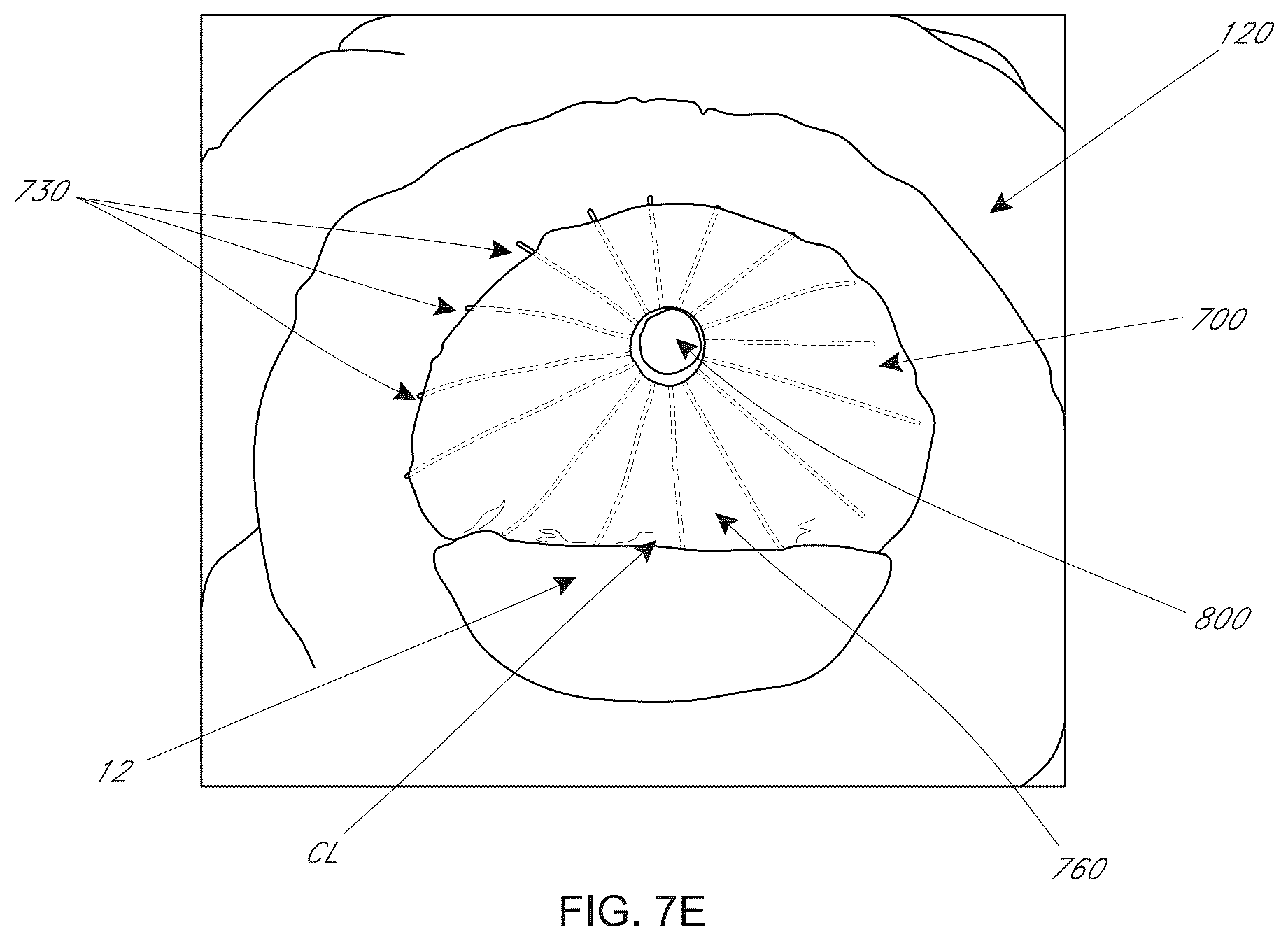 Patent US12616574 Figure 19 – Device, system, and method for transcatheter treatment of valvular regurgitation