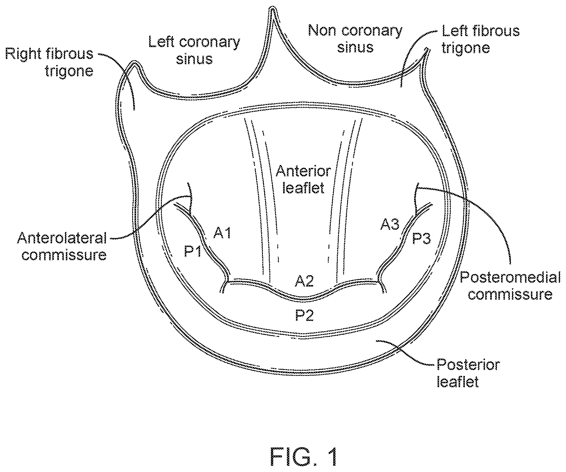 Patent US12616575 Figure 1 – Leaflet extension for cardiac valve leaflet