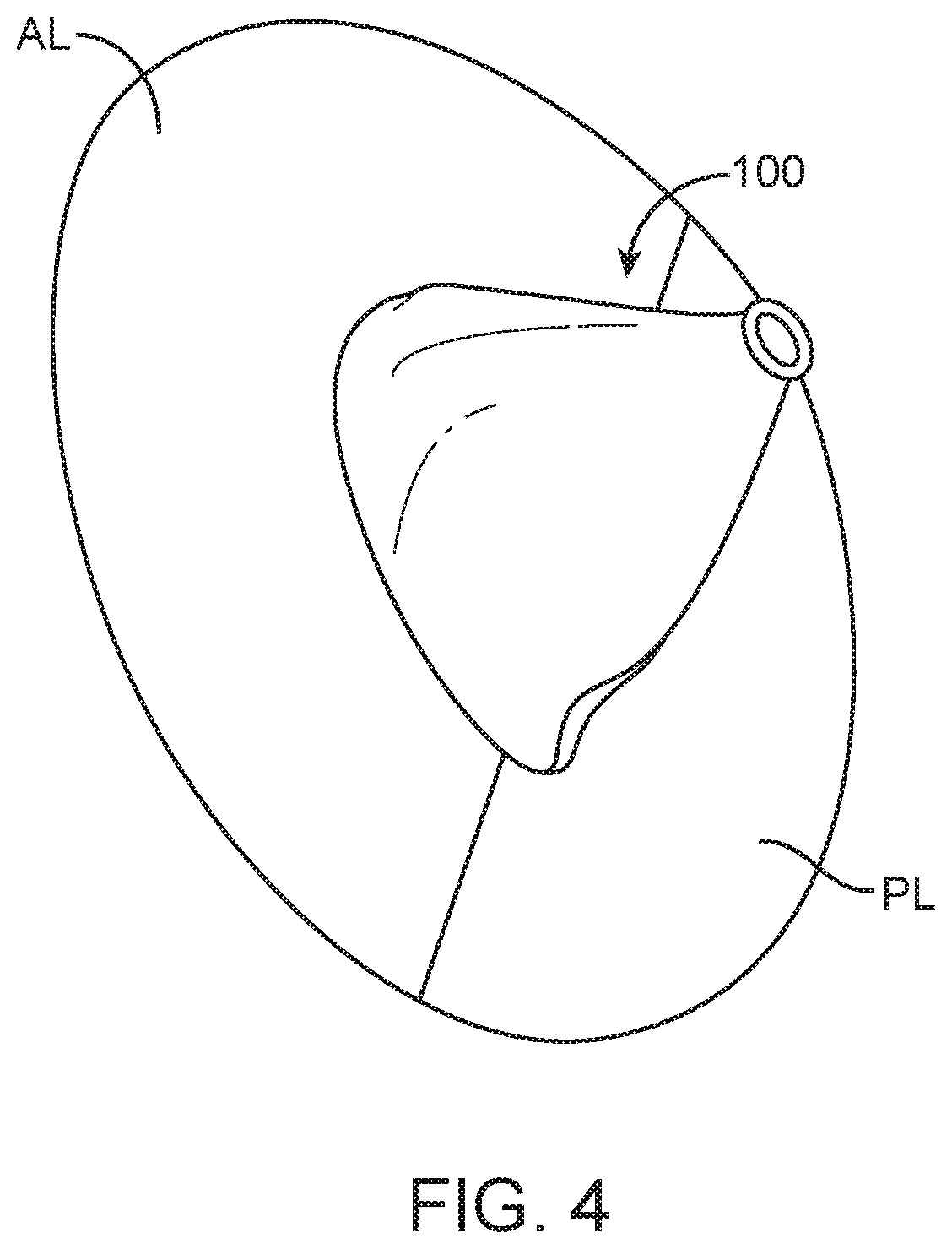 Patent US12616575 Figure 6 – Leaflet extension for cardiac valve leaflet
