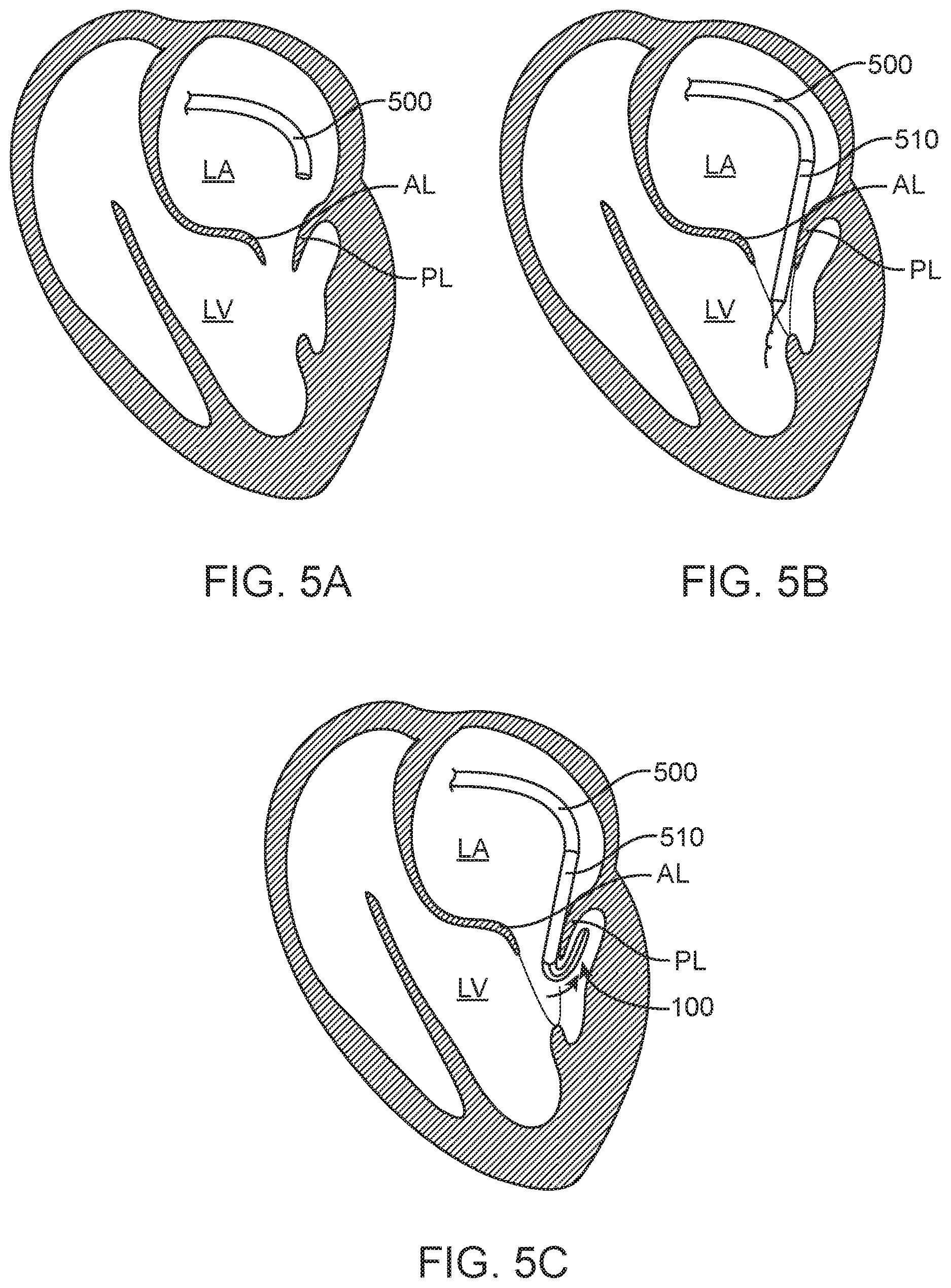 Patent US12616575 Figure 7 – Leaflet extension for cardiac valve leaflet