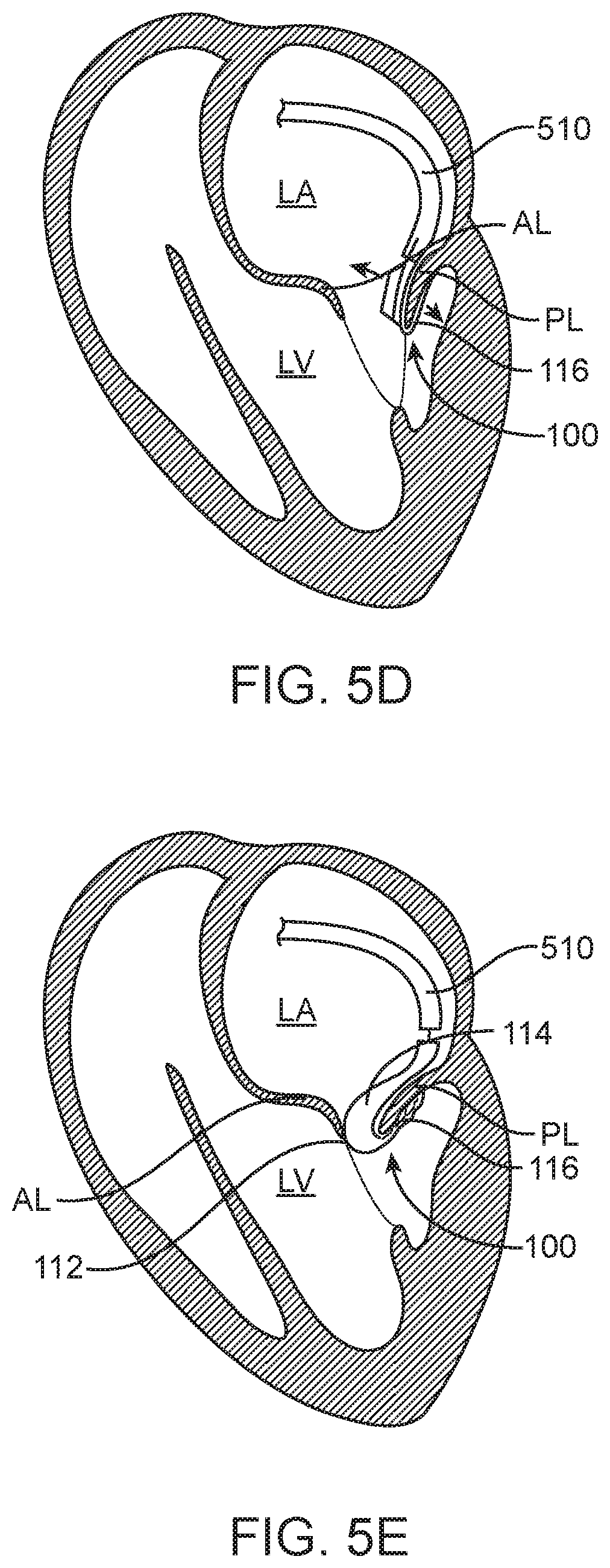 Patent US12616575 Figure 8 – Leaflet extension for cardiac valve leaflet