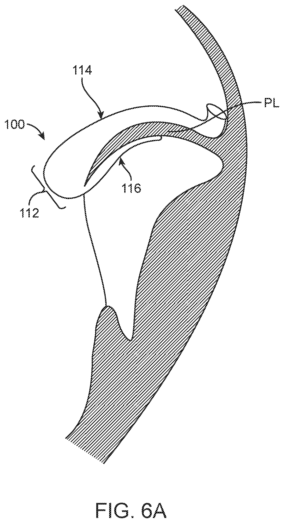 Patent US12616575 Figure 9 – Leaflet extension for cardiac valve leaflet