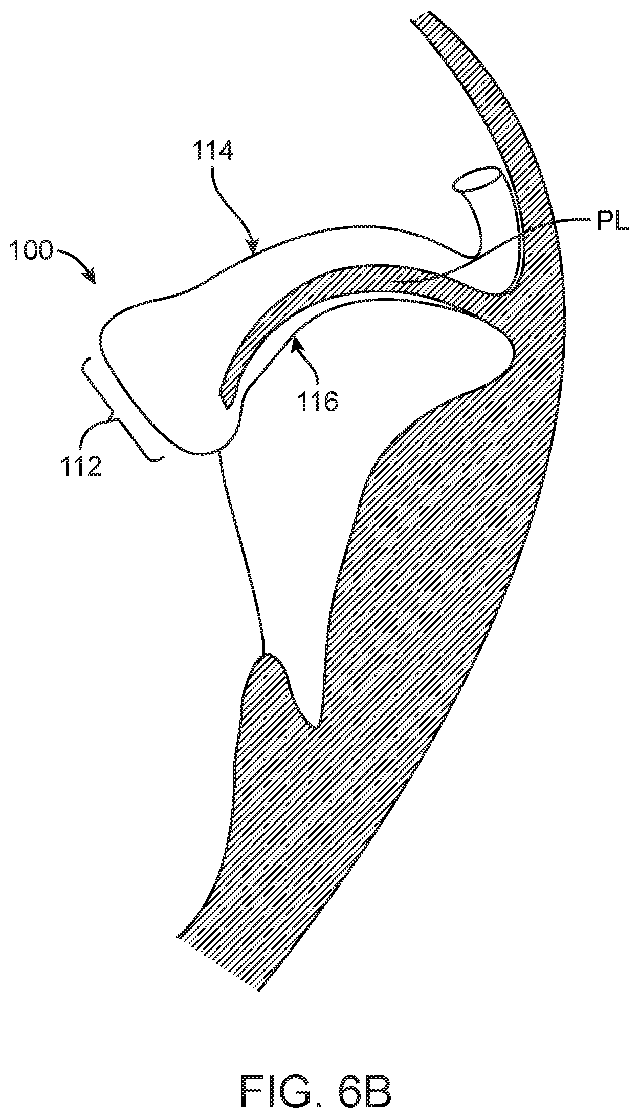 Patent US12616575 Figure 10 – Leaflet extension for cardiac valve leaflet