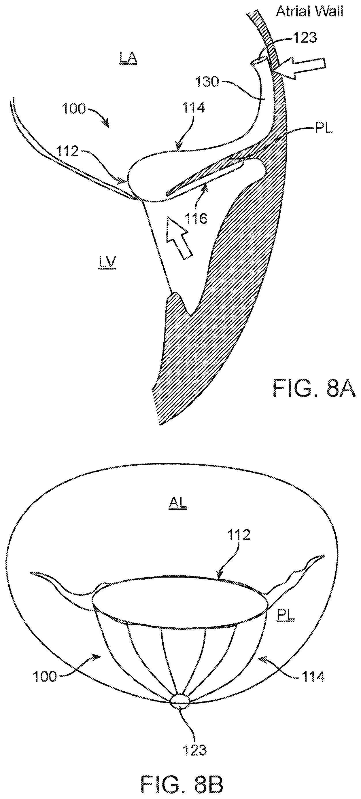 Patent US12616575 Figure 12 – Leaflet extension for cardiac valve leaflet