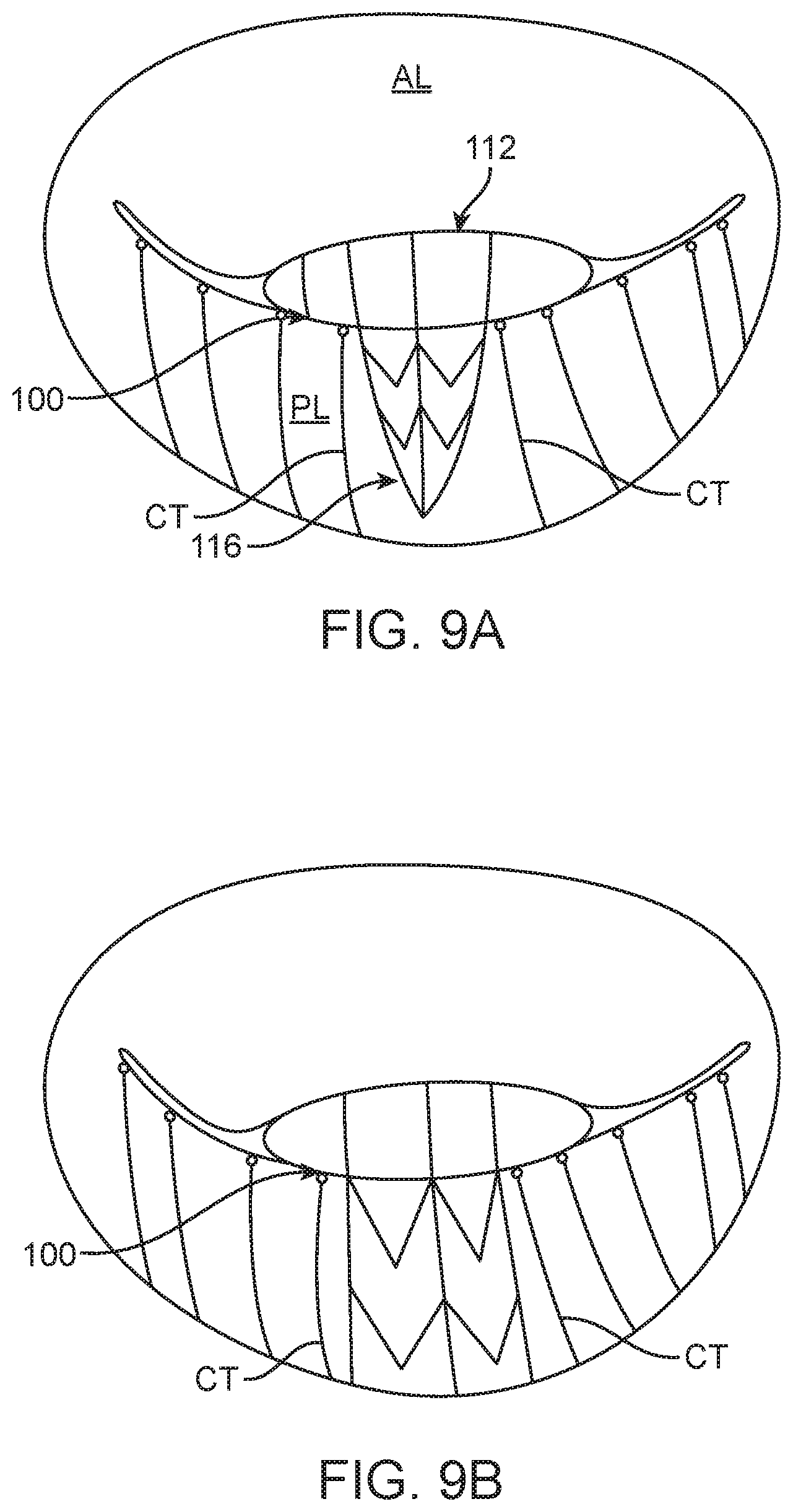 Patent US12616575 Figure 13 – Leaflet extension for cardiac valve leaflet