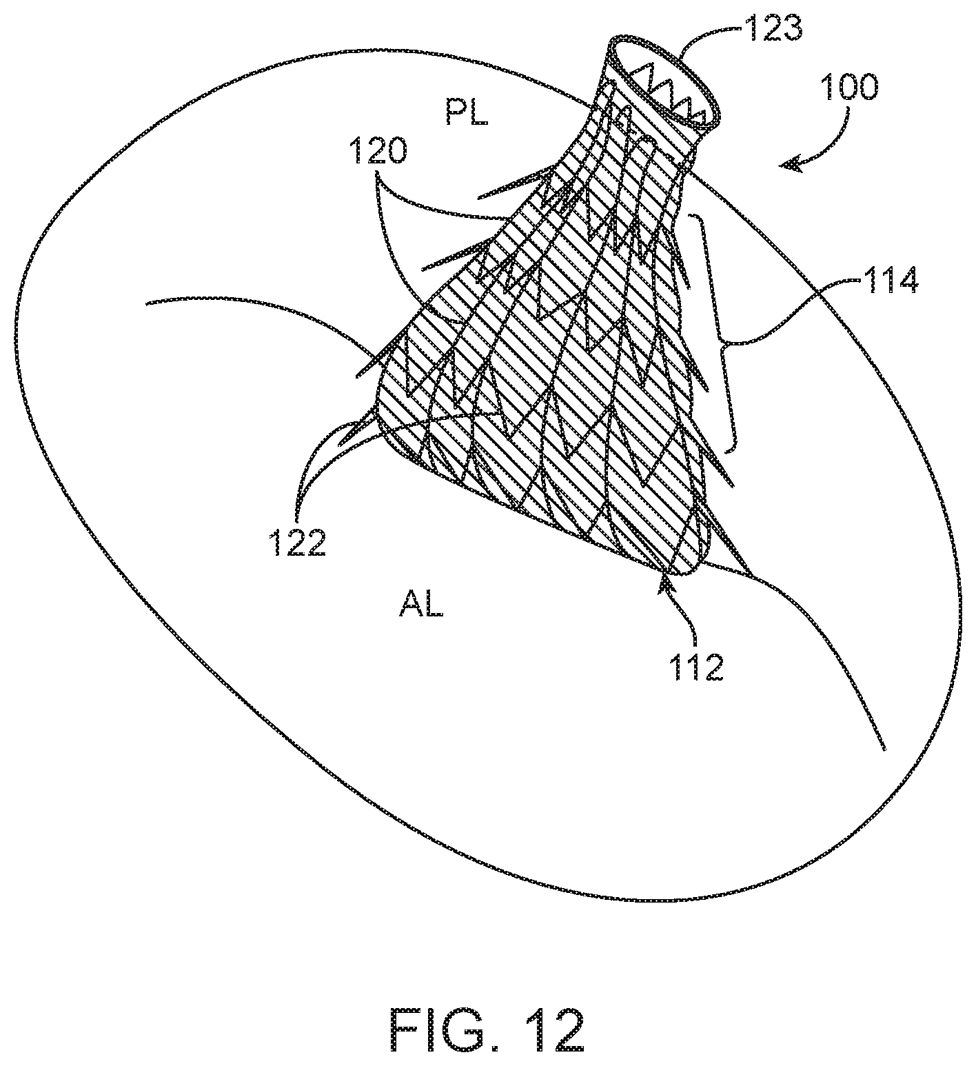 Patent US12616575 Figure 18 – Leaflet extension for cardiac valve leaflet