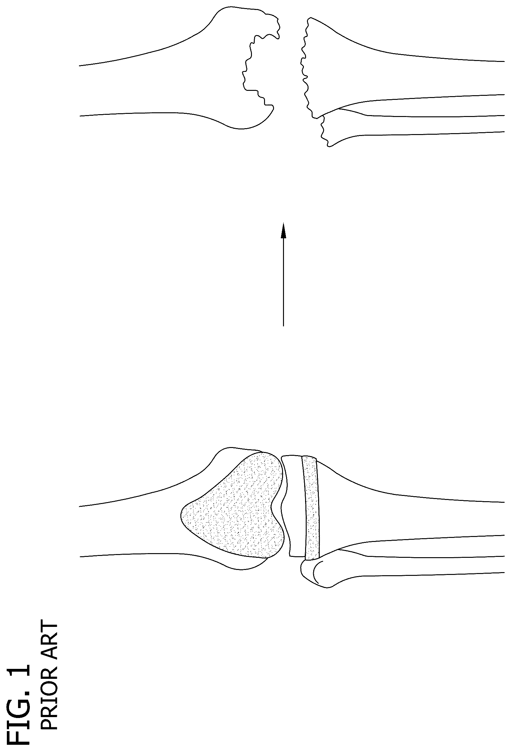 Patent US12616577 Figure 1 – Hinged articulating spacer system for revision knee arthroplasty